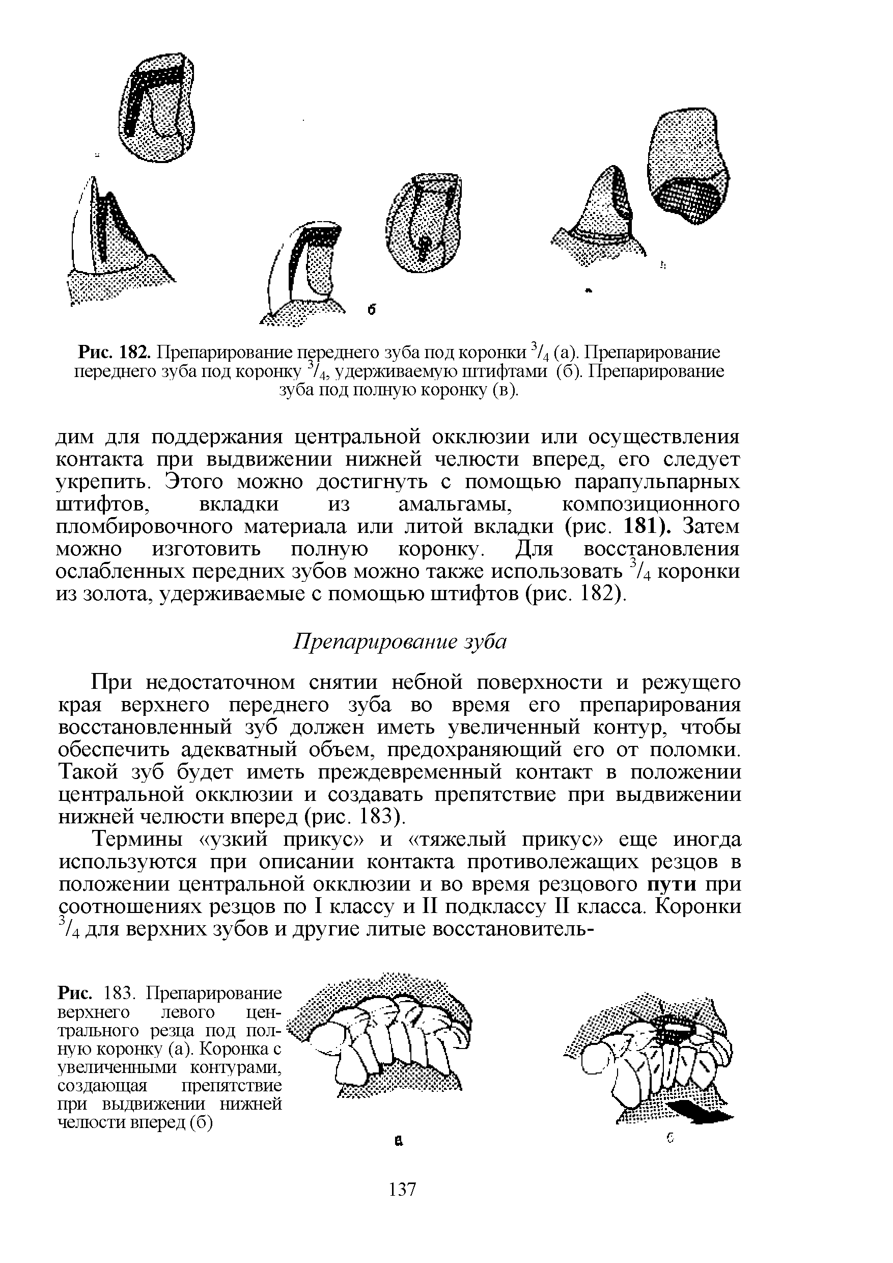 Рис. 183. Препарирование верхнего левого центрального резца под полную коронку (а). Коронка с увеличенными контурами, создающая препятствие при выдвижении нижней челюсти вперед (б)...