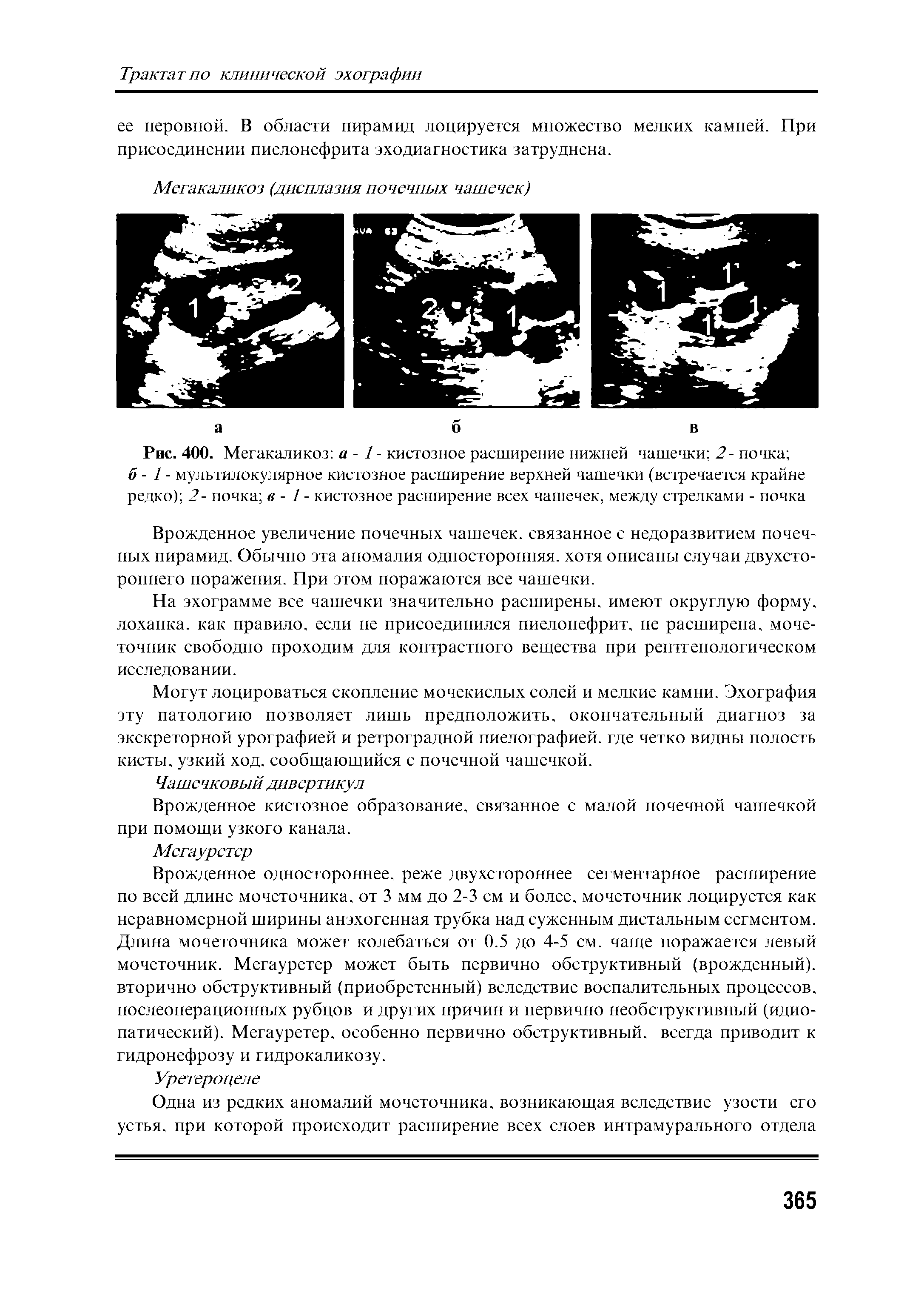 Рис. 400. Мегакаликоз а - 1 - кистозное расширение нижней чашечки 2- почка б - 1 - мультилокулярное кистозное расширение верхней чашечки (встречается крайне редко) 2- почка в - 1 - кистозное расширение всех чашечек, между стрелками - почка...