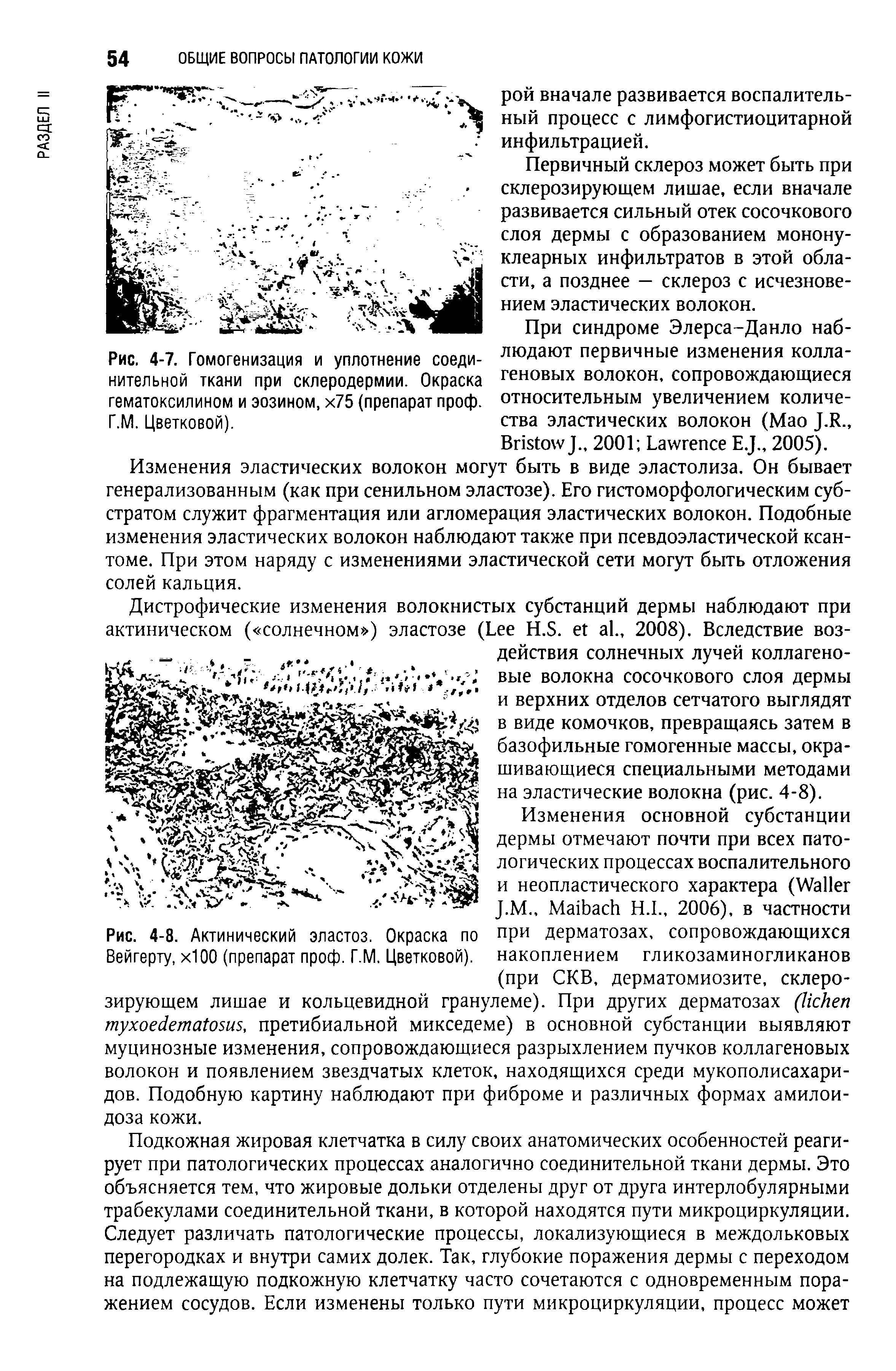 Рис. 4-8. Актинический эластоз. Окраска по при дерматозах, сопровождающихся Вейгерту, х100 (препарат проф. Г.М. Цветковой), накоплением гликозаминогликанов (при СКВ, дерматомиозите, склерозирующем лишае и кольцевидной гранулеме). При других дерматозах ( , претибиальной микседеме) в основной субстанции выявляют...