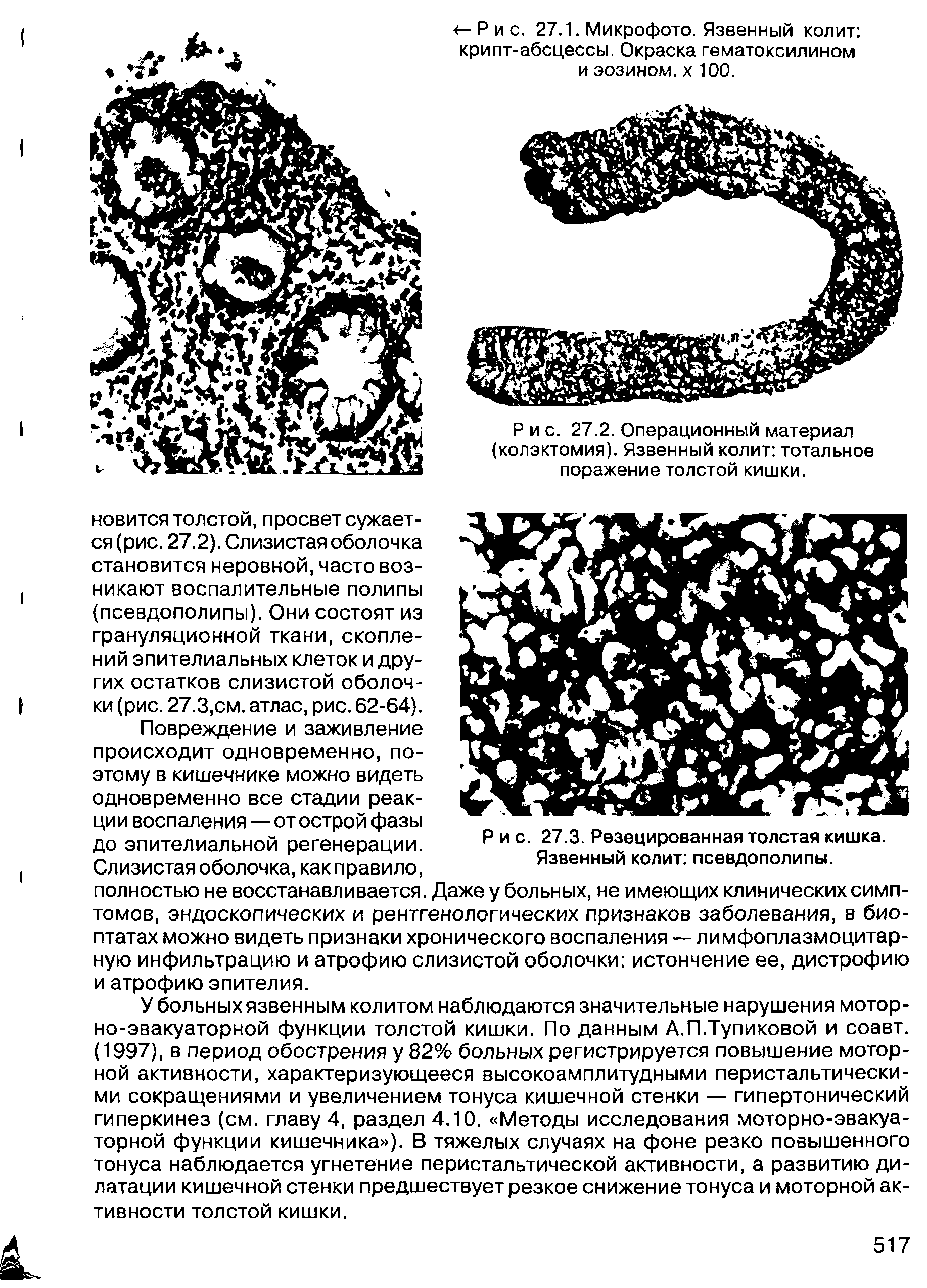 Рис. 27.3. Резецированная толстая кишка. Язвенный колит псевдополипы.