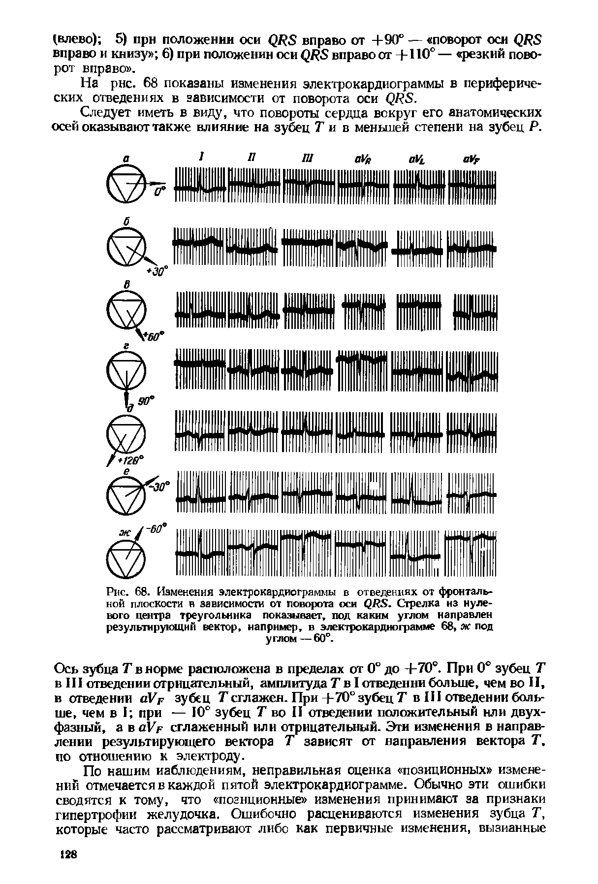 Рис. 68. Изменения электрокардиограммы в отведениях от фронтальной плоскости в зависимости от поворота оси QRS. Стрелка из нулевого центра треугольника показывает, под каким углом направлен результирующий вектор, например, в электрокардиограмме 68, яс под углом — 60°.