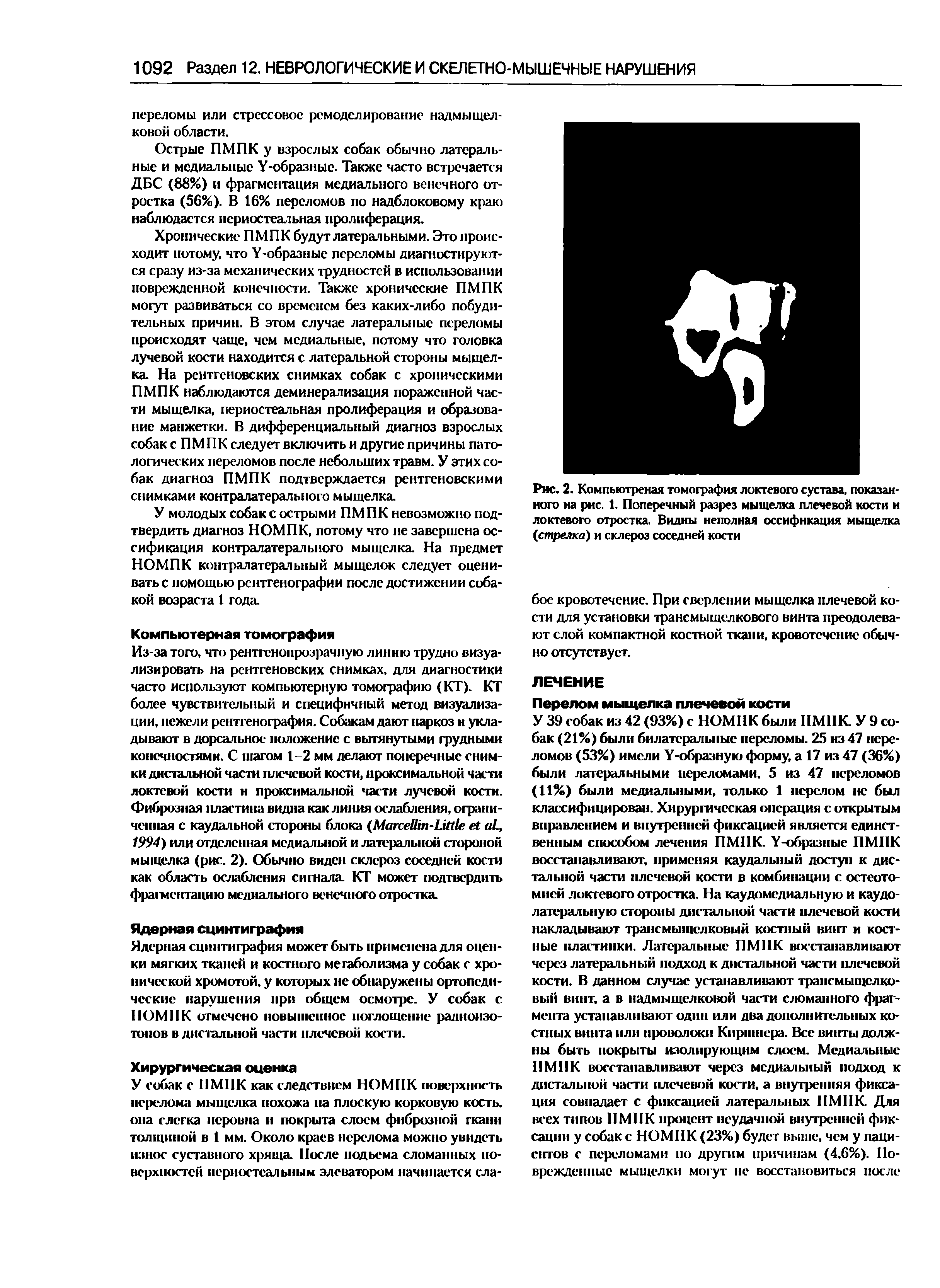 Рис. 2. Компьютреная томография локтевого сустава, показанного на рис. 1. Поперечный разрез мыщелка плечевой кости и локтевого отростка. Видны неполная оссифнкация мыщелка (стрелка) и склероз соседней кости...