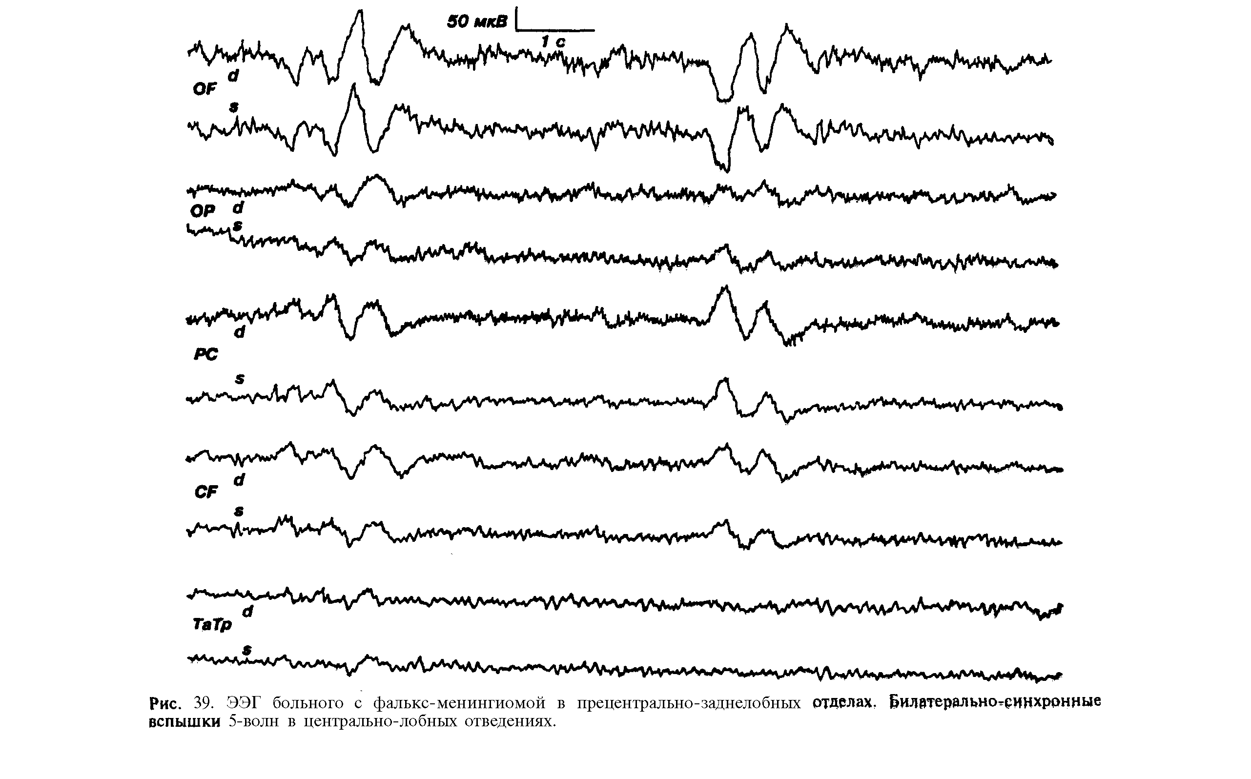 Рис. 39. ЭЭГ больного с фалькс-менингиомой в прецентрально-заднелобных отделах. Билвтерально-ринхррнные вспышки 5-волн в центрально-лобных отведениях.