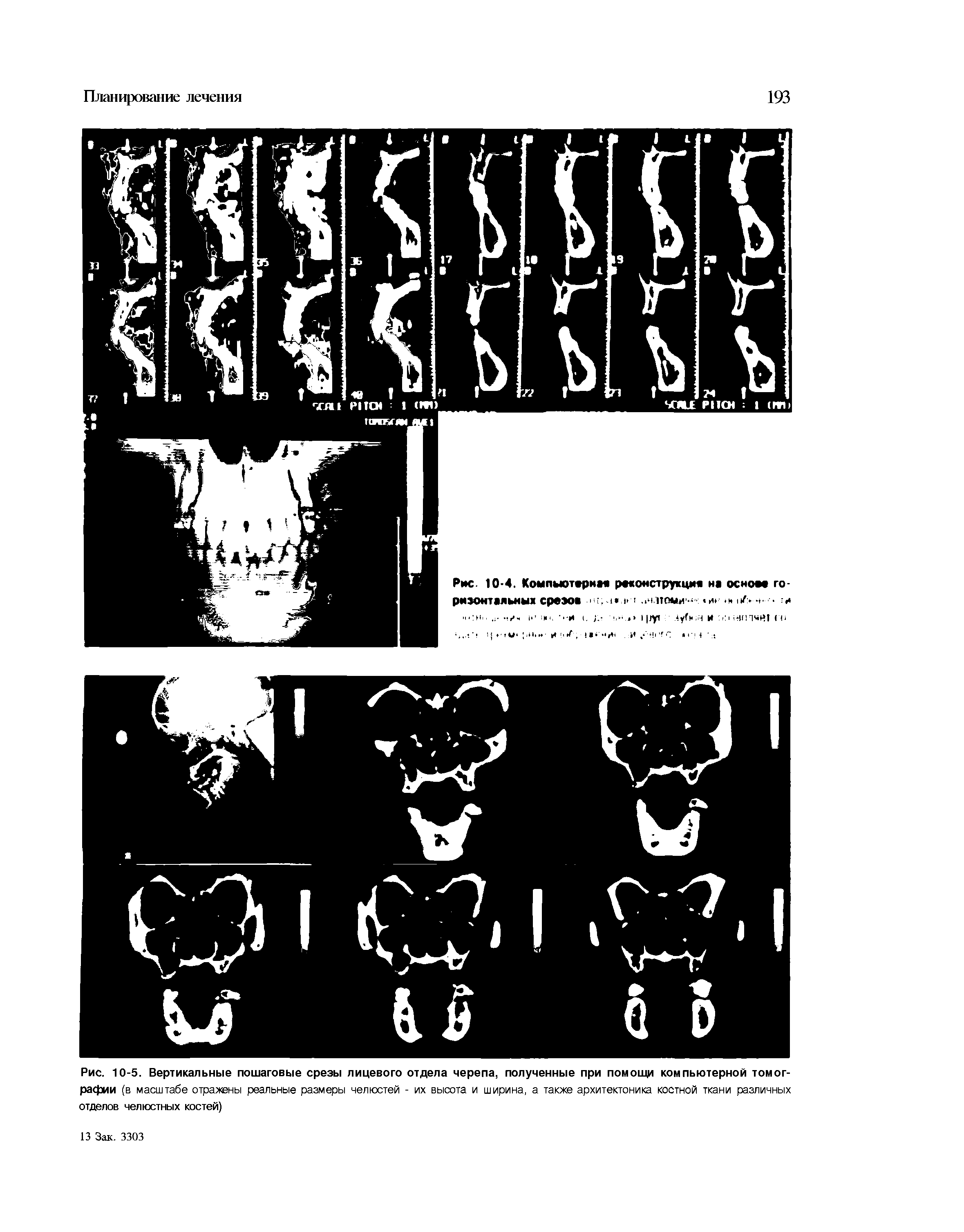 Рис. 10-5. Вертикальные пошаговые срезы лицевого отдела черепа, полученные при помошй компьютерной томографии (в масштабе отражены реальные размеры челюстей - их высота и ширина, а также архитектоника костной ткани различных отделов челюстных костей)...