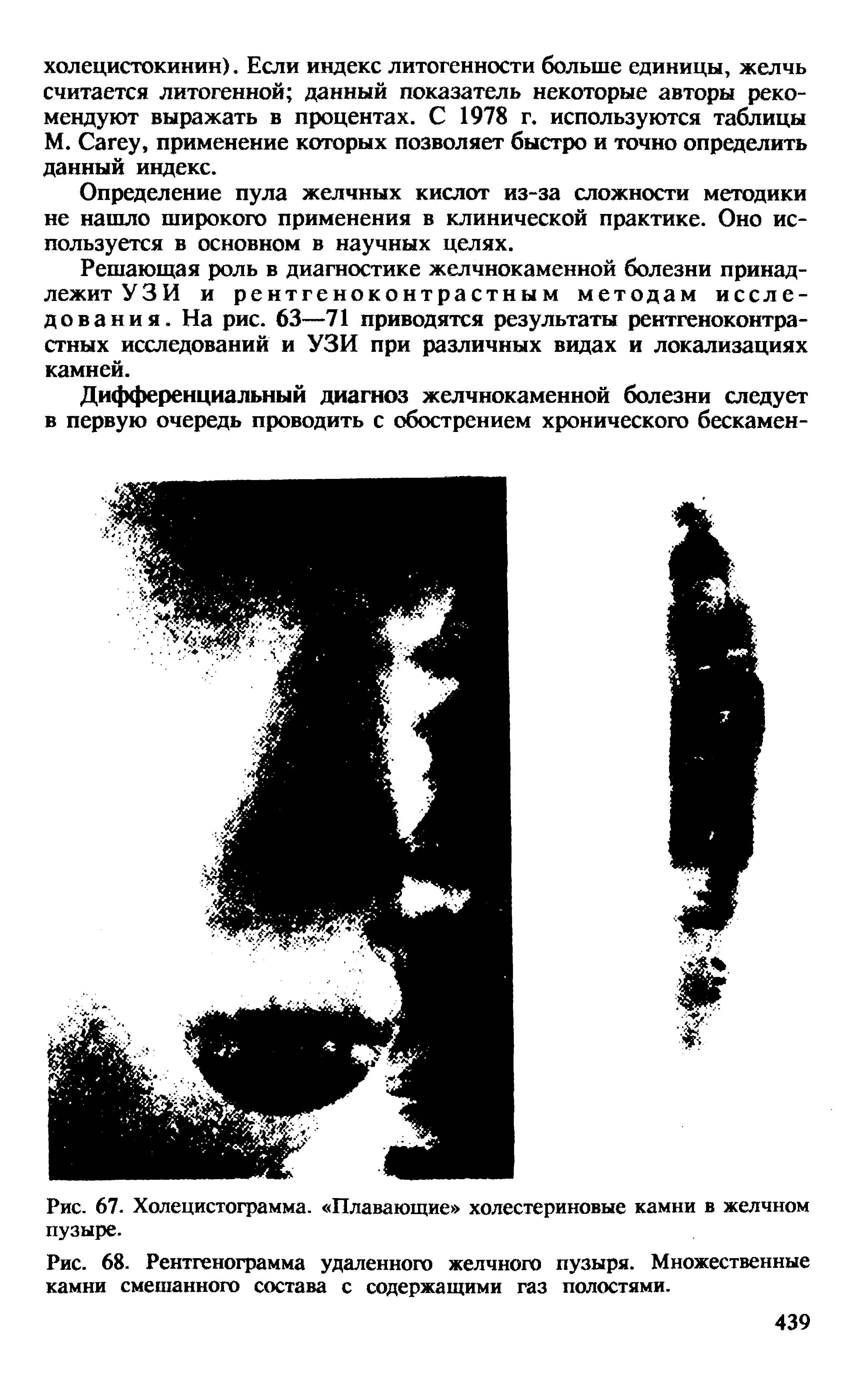 Рис. 68. Рентгенограмма удаленного желчного пузыря. Множественные камни смешанного состава с содержащими газ полостями.