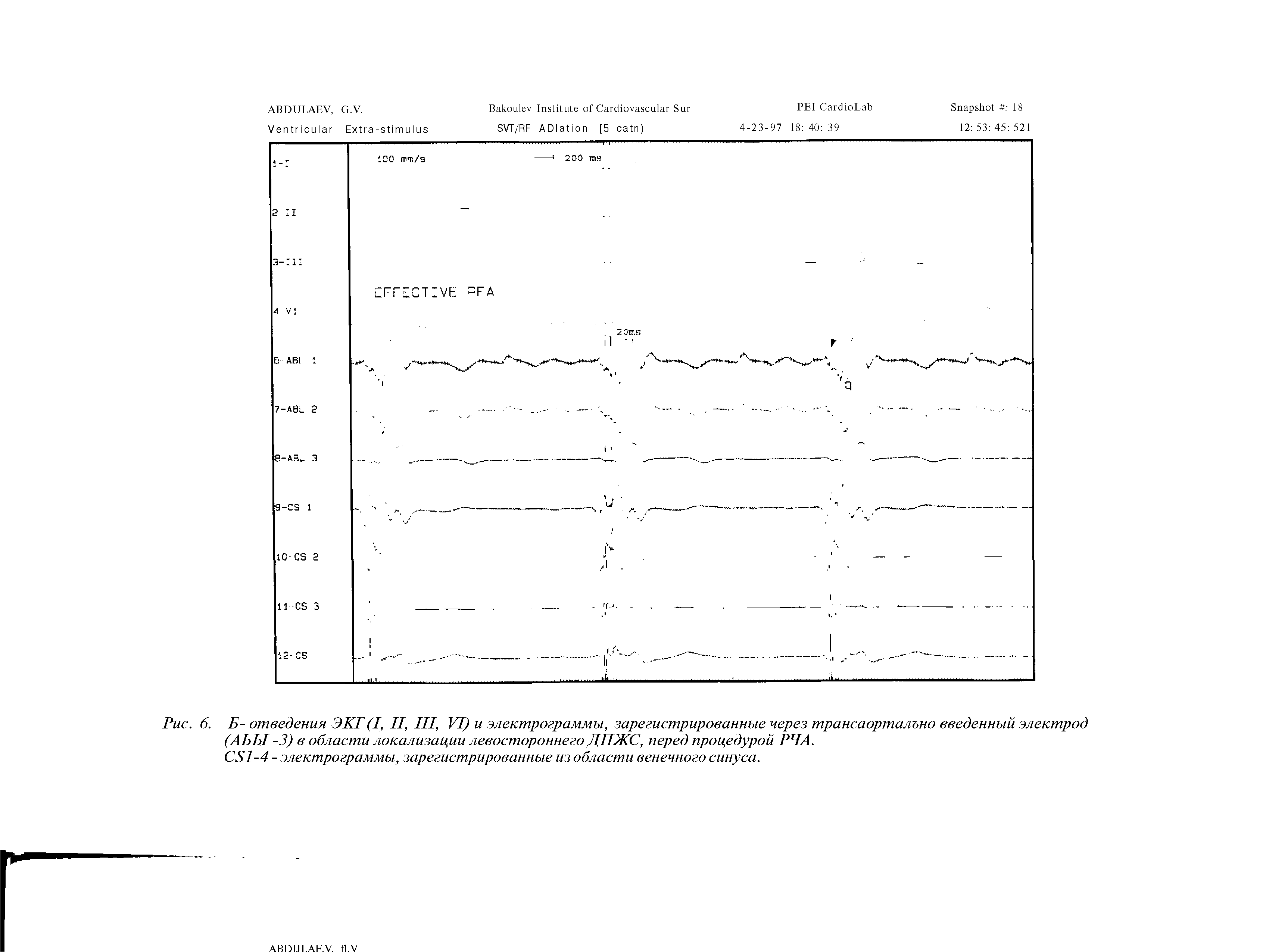 Рис. 6. Б- отведения ЭКГ (I, II, III, VI) и электрограммы, зарегистрированные через трансаорталъно введенный электрод (АЬЫ -3) в области локализации левостороннего ДПЖС, перед процедурой РЧА.