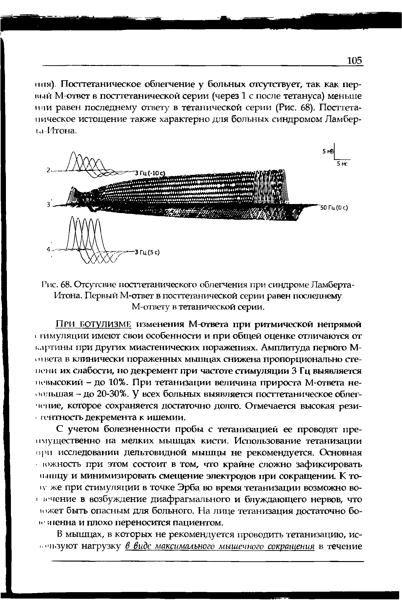 Рис. 68. Отсу гсвие посттетанического облегчения при синдроме Ламберта-Итона. Первый М-ответ в посттетанической серии равен последнему М-ответу в тетанической серии.