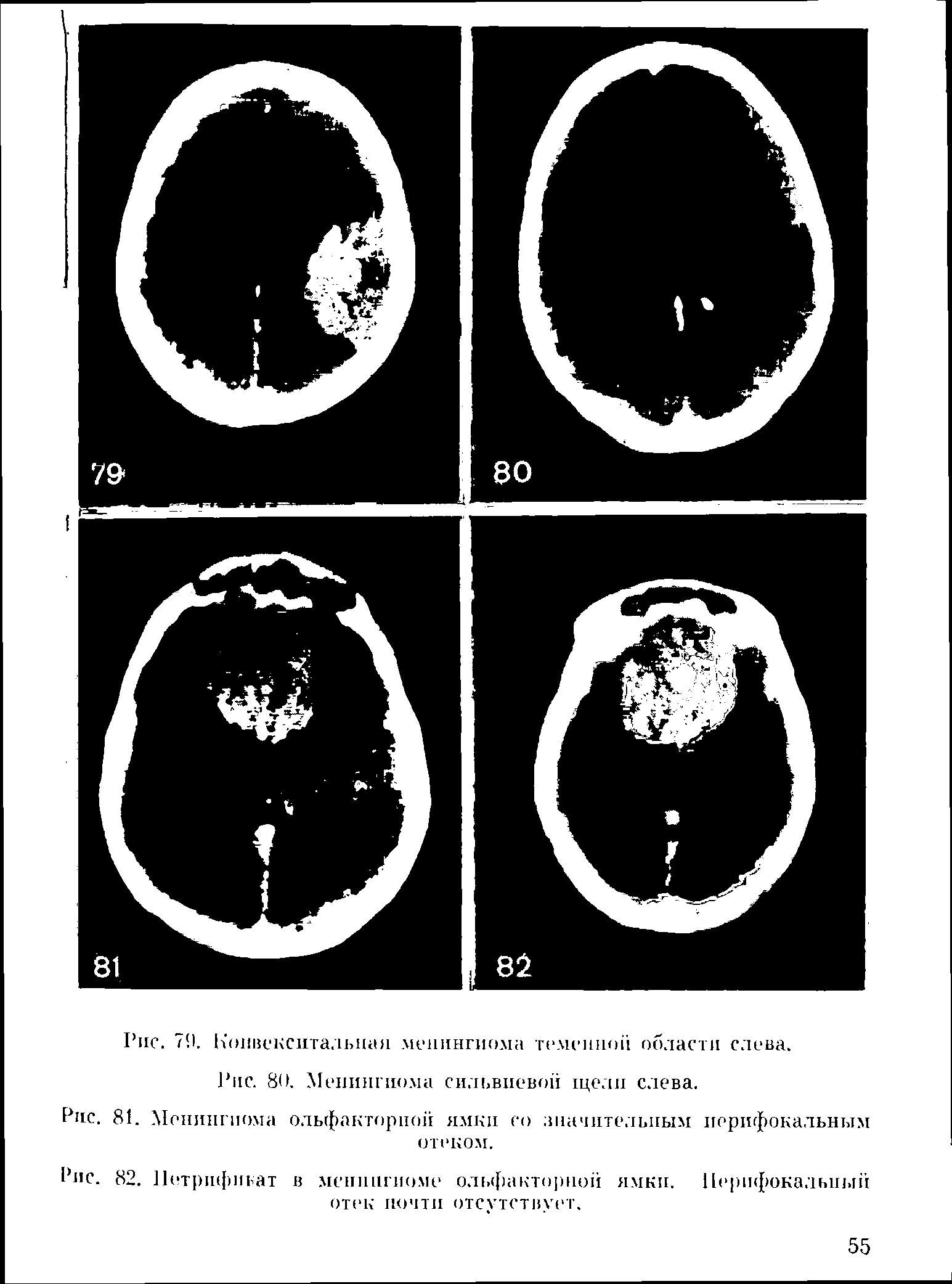 Рис. 81. Менингиома ольфакторной ямки со значительным перифокальным отеком.