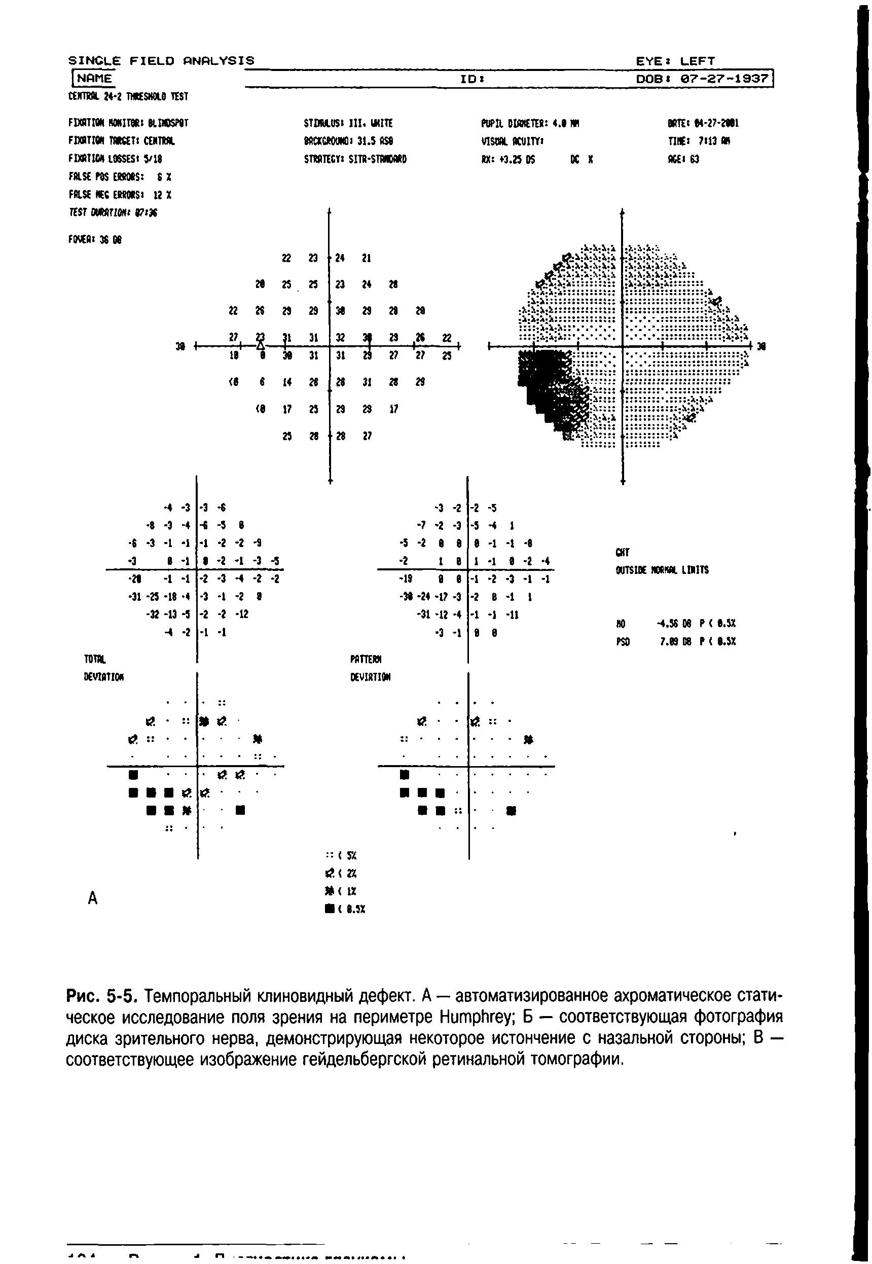 Рис. 5-5. Темпоральный клиновидный дефект. А — автоматизированное ахроматическое статическое исследование поля зрения на периметре H Б — соответствующая фотография диска зрительного нерва, демонстрирующая некоторое истончение с назальной стороны В — соответствующее изображение гейдельбергской ретинальной томографии.