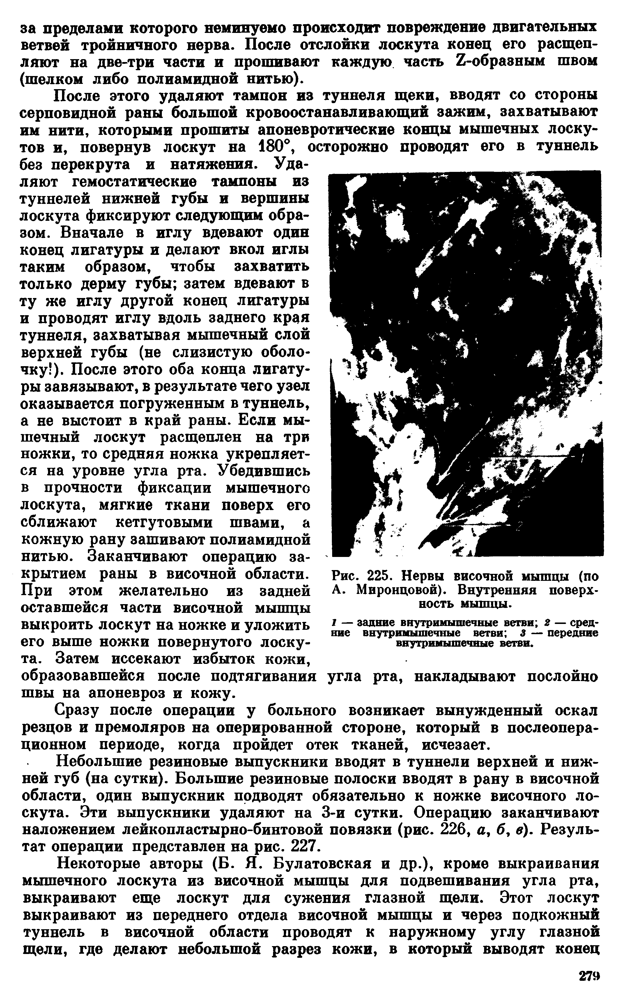 Рис. 225. Нервы височной мышцы (по А. Миронцовой). Внутренняя поверхность мышцы.