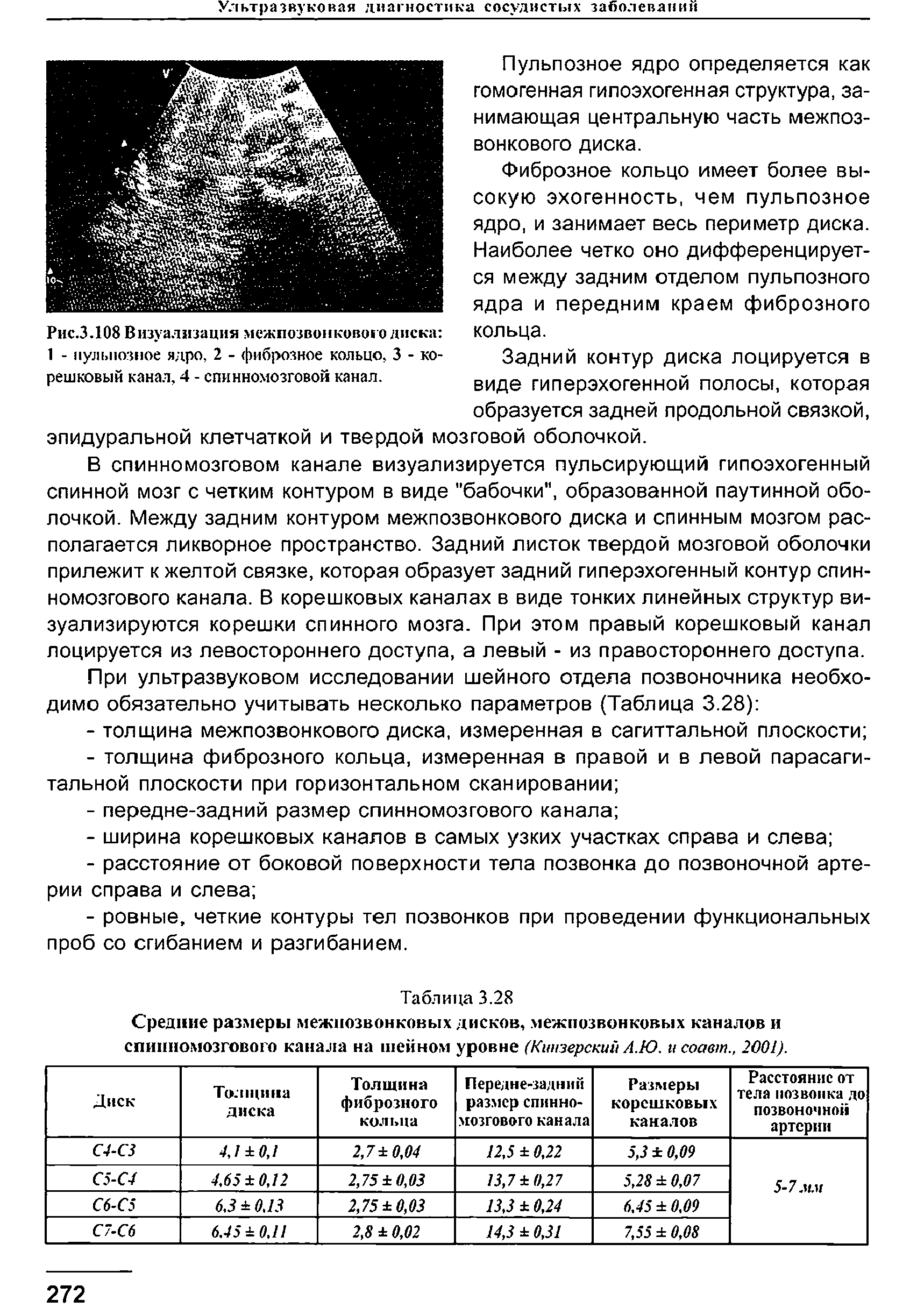 Рис.3.108 Визуализация межпозвонкового диска 1 - пульпозное ядро, 2 - фиброзное кольцо. 3 - корешковый канал, 4 - спинномозговой канал.