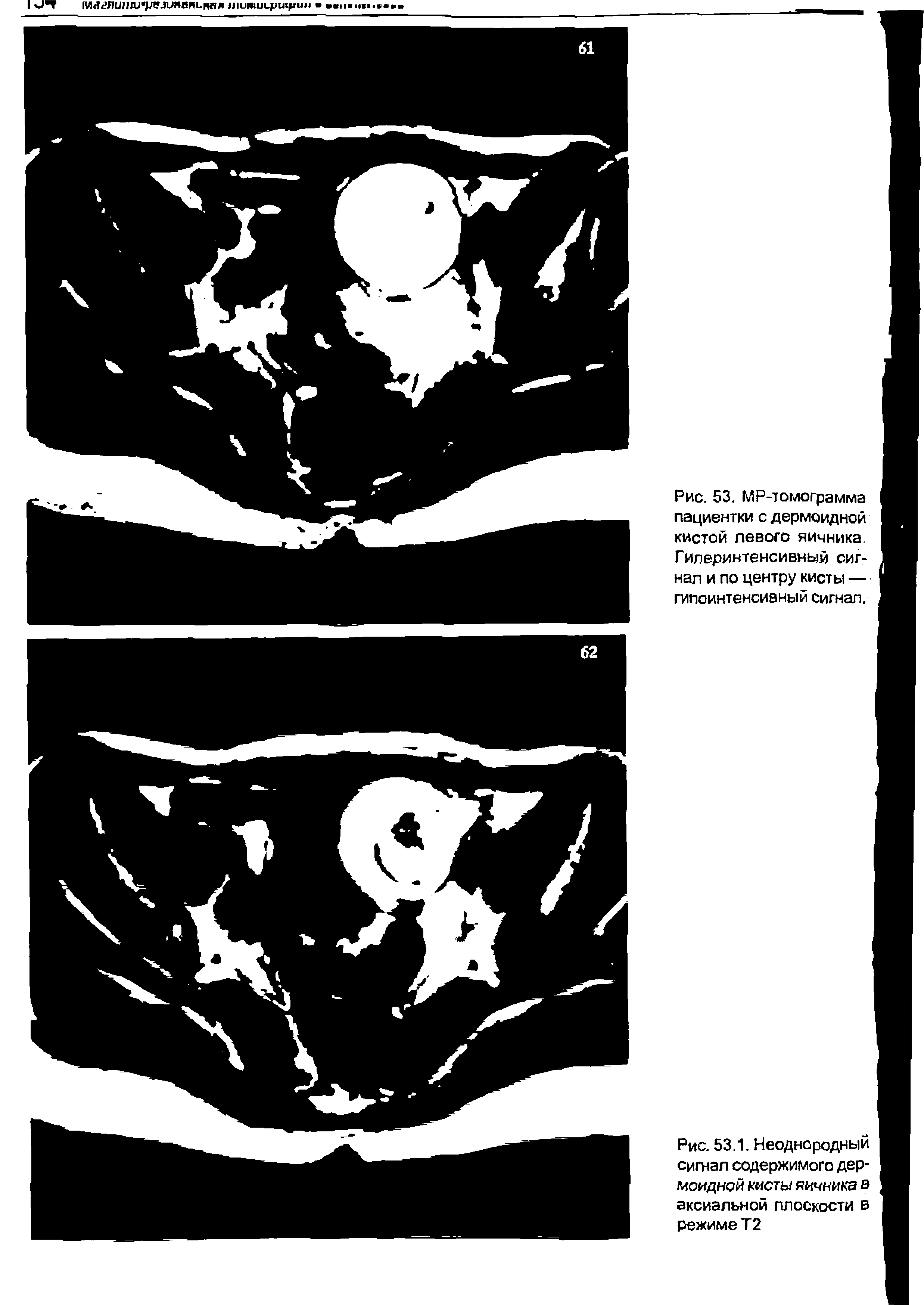 Рис. 53.1. Неоднородный сигнал содержимого дермоидной кисты яичника в аксиальной плоскости в режиме Т2...