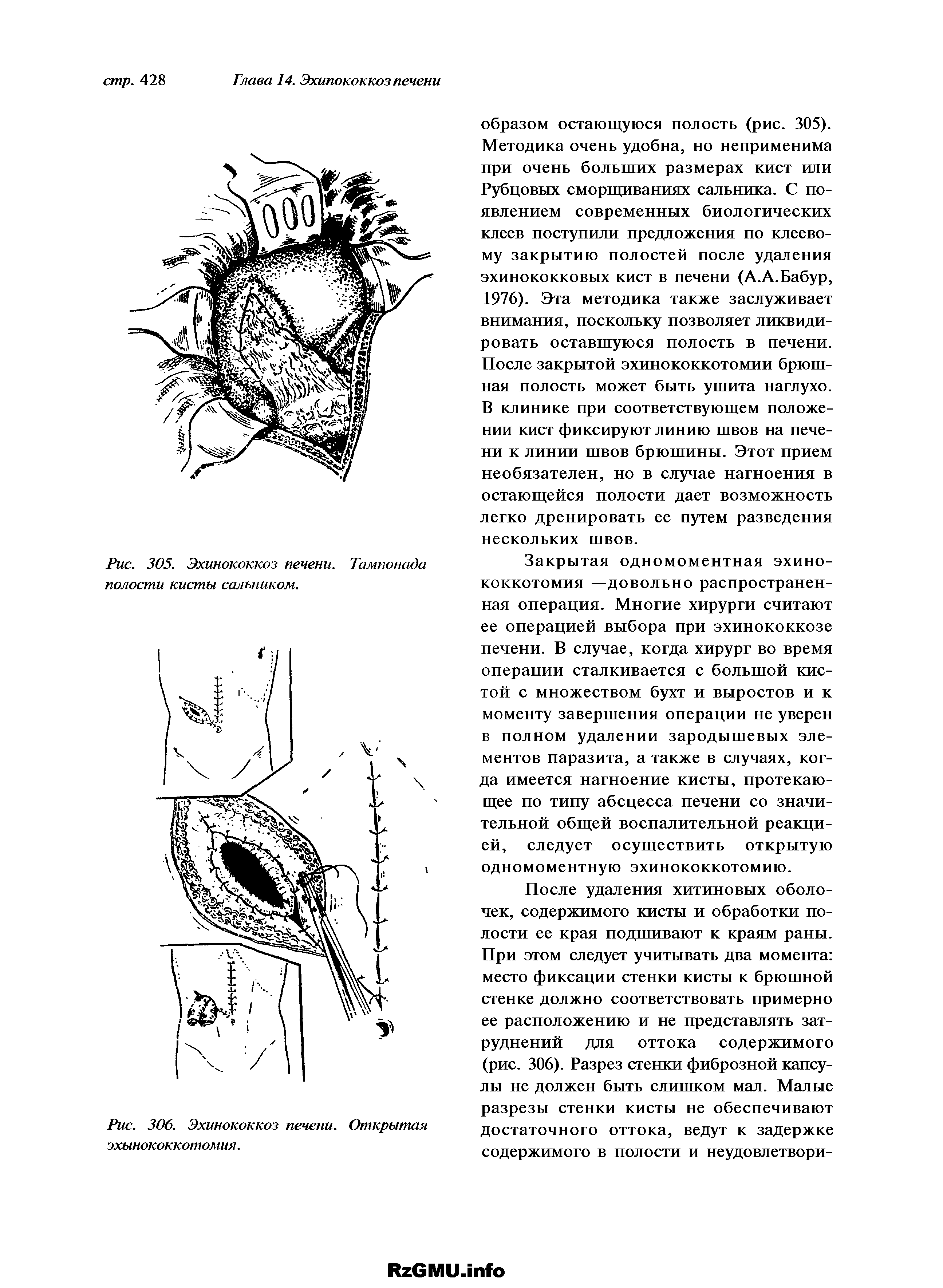 Рис. 305. Эхинококкоз печени. Тампонада полости кисты сальником.