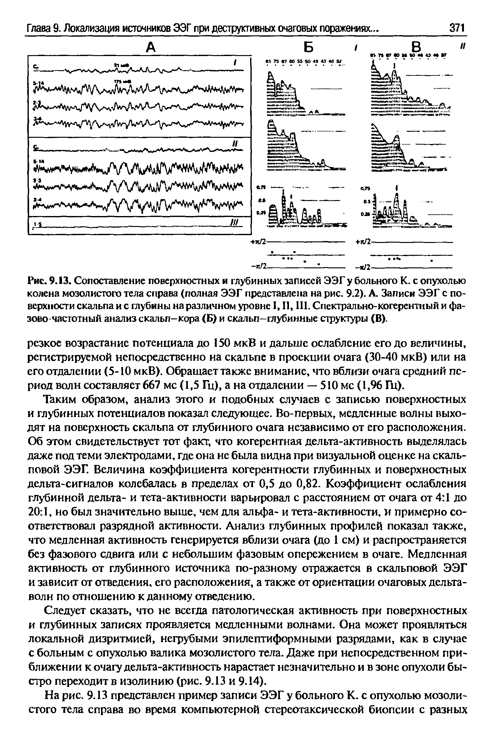 Рис. 9.13. Сопоставление поверхностных и глубинных записей ЭЭГ у больного К. с опухолью колена мозолистого тела справа (полная ЭЭГ представлена на рис. 9.2). А. Записи ЭЭГ с поверхности скальпа и с глубины на различном уровне 1,11,111. Спектрально-когерентный и фазово-частотный анализ скальп-кора (Б) и скальп-глубинные структуры (В).