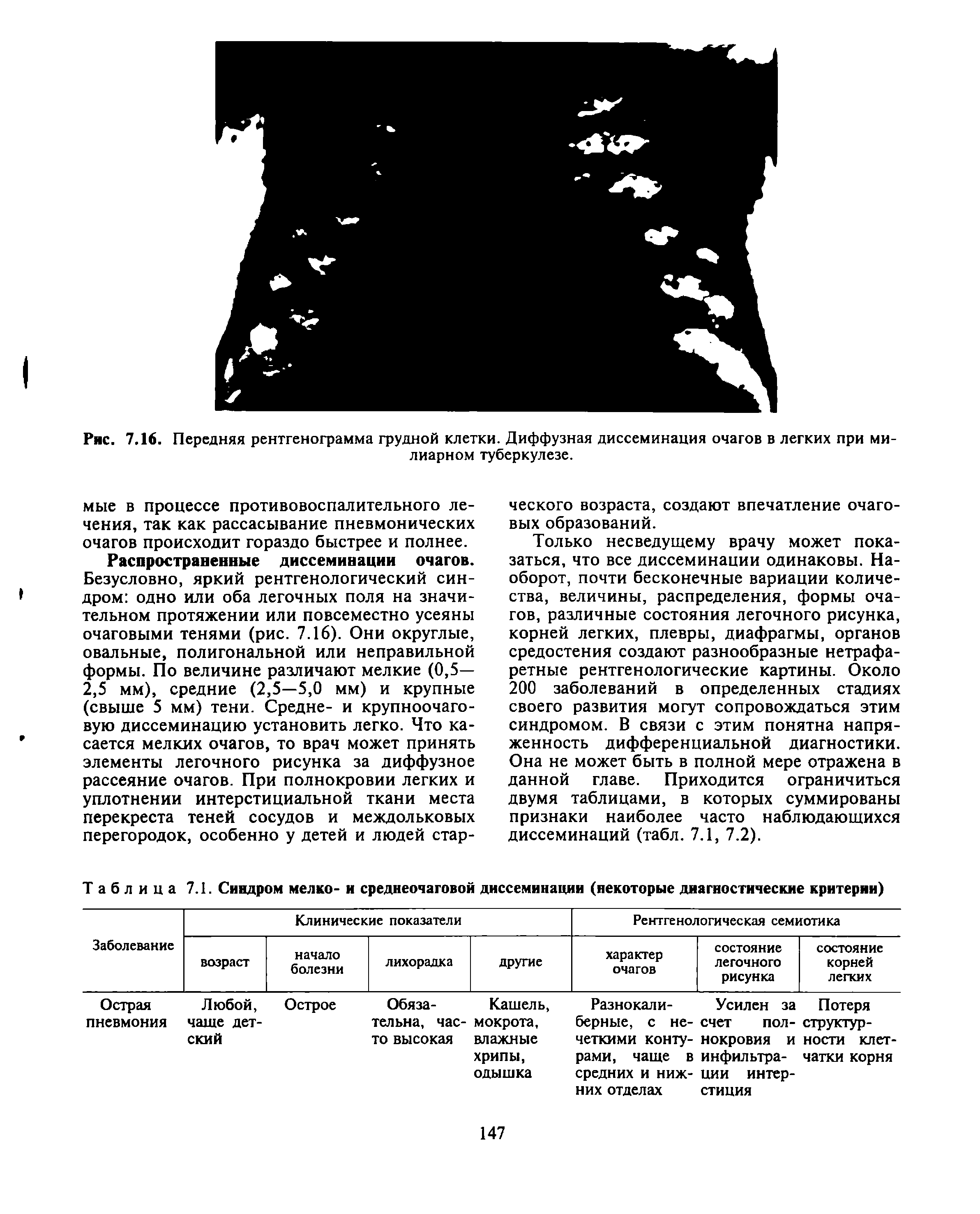 Рис. 7.16. Передняя рентгенограмма грудной клетки. Диффузная диссеминация очагов в легких при милиарном туберкулезе.