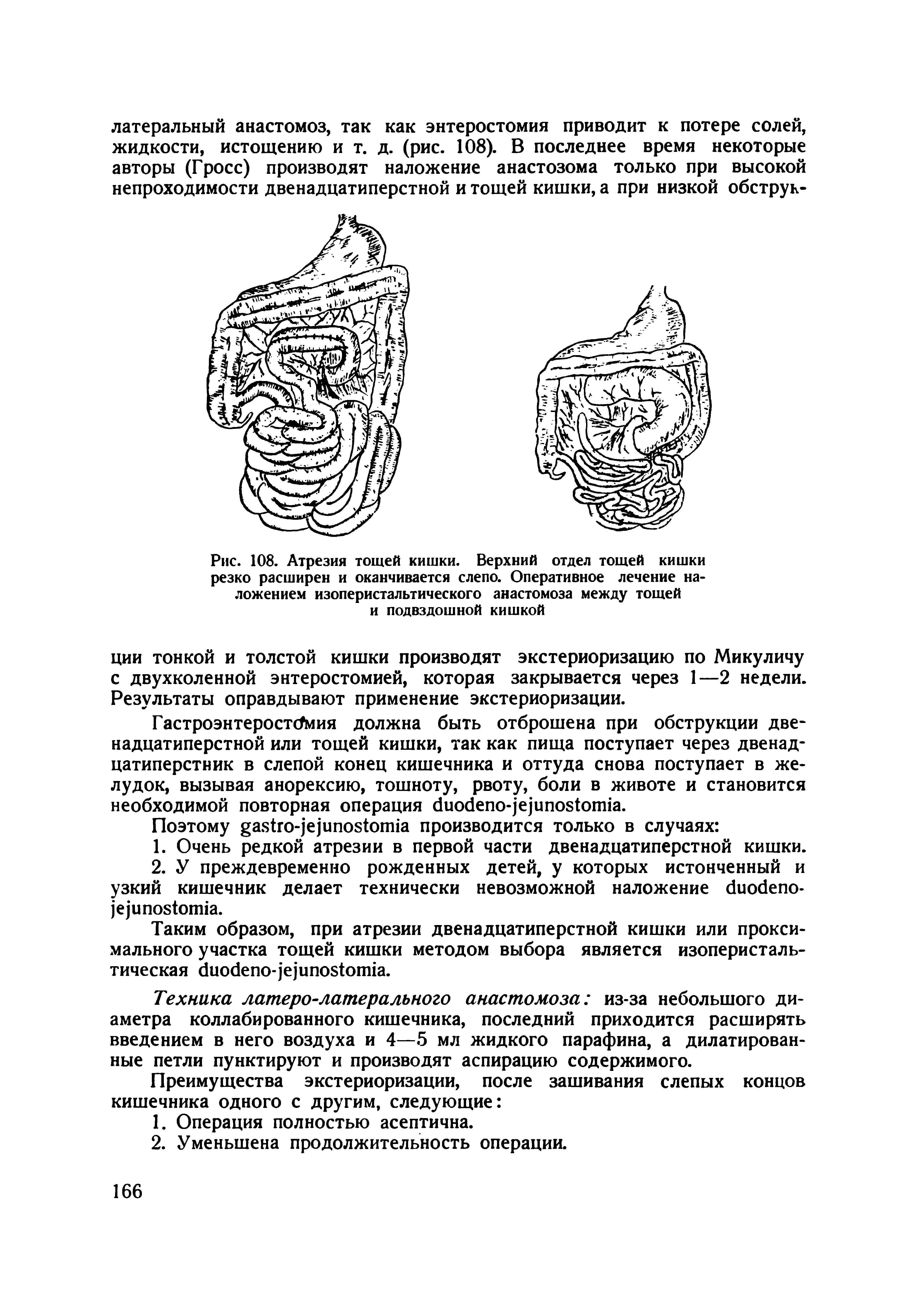 Рис. 108. Атрезия тощей кишки. Верхний отдел тощей кишки резко расширен и оканчивается слепо. Оперативное лечение наложением изоперистальтического анастомоза между тощей и подвздошной кишкой...