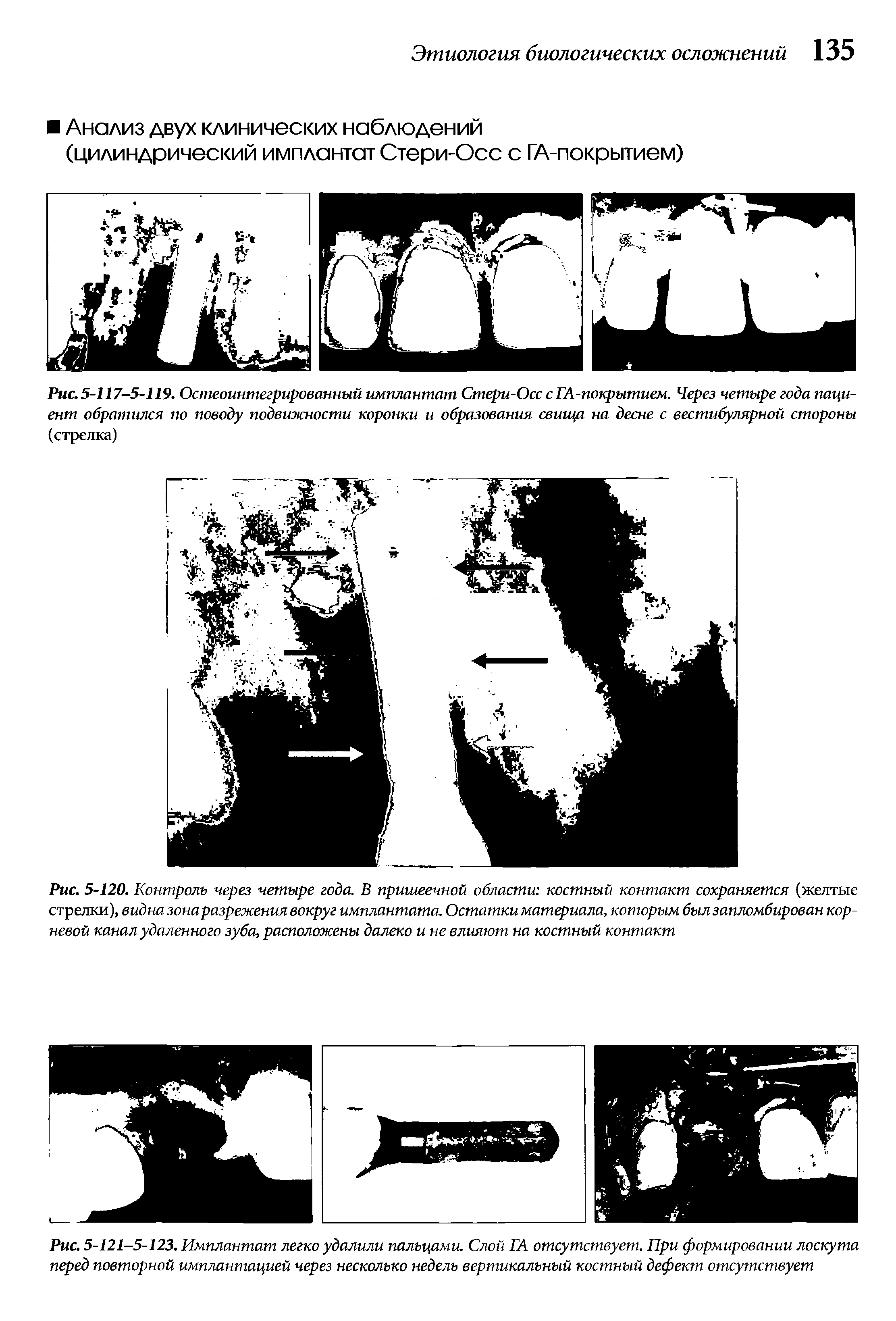 Рис. 5-121-5-123. Имплантат легко удалили пальцами. Слой ГА отсутствует. При формировании лоскута перед повторной имплантацией через несколько недель вертикальный костный дефект отсутствует...