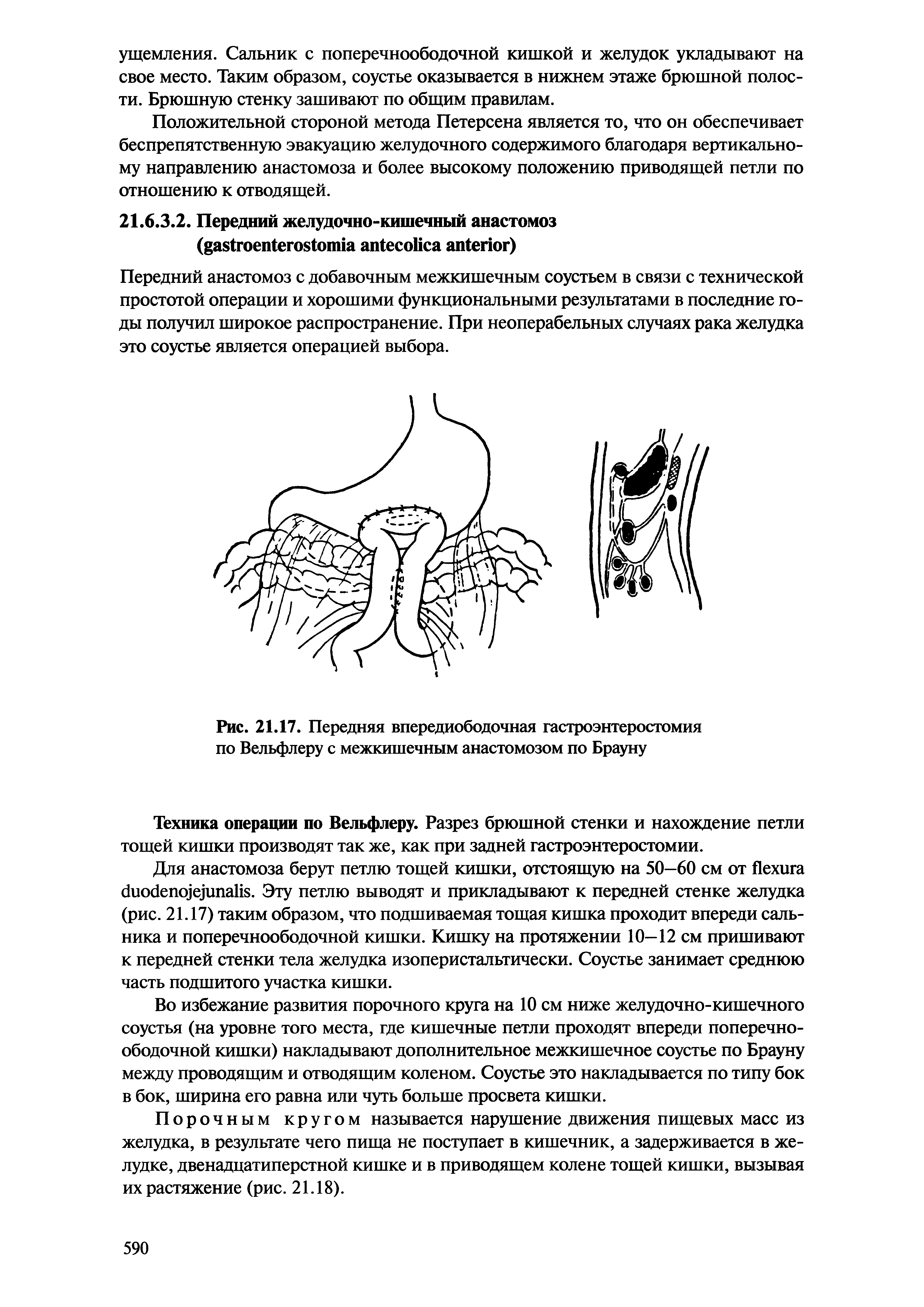 Рис. 21.17. Передняя впередиободочная гастроэнтеростомия по Бельфлеру с межкишечным анастомозом по Брауну...