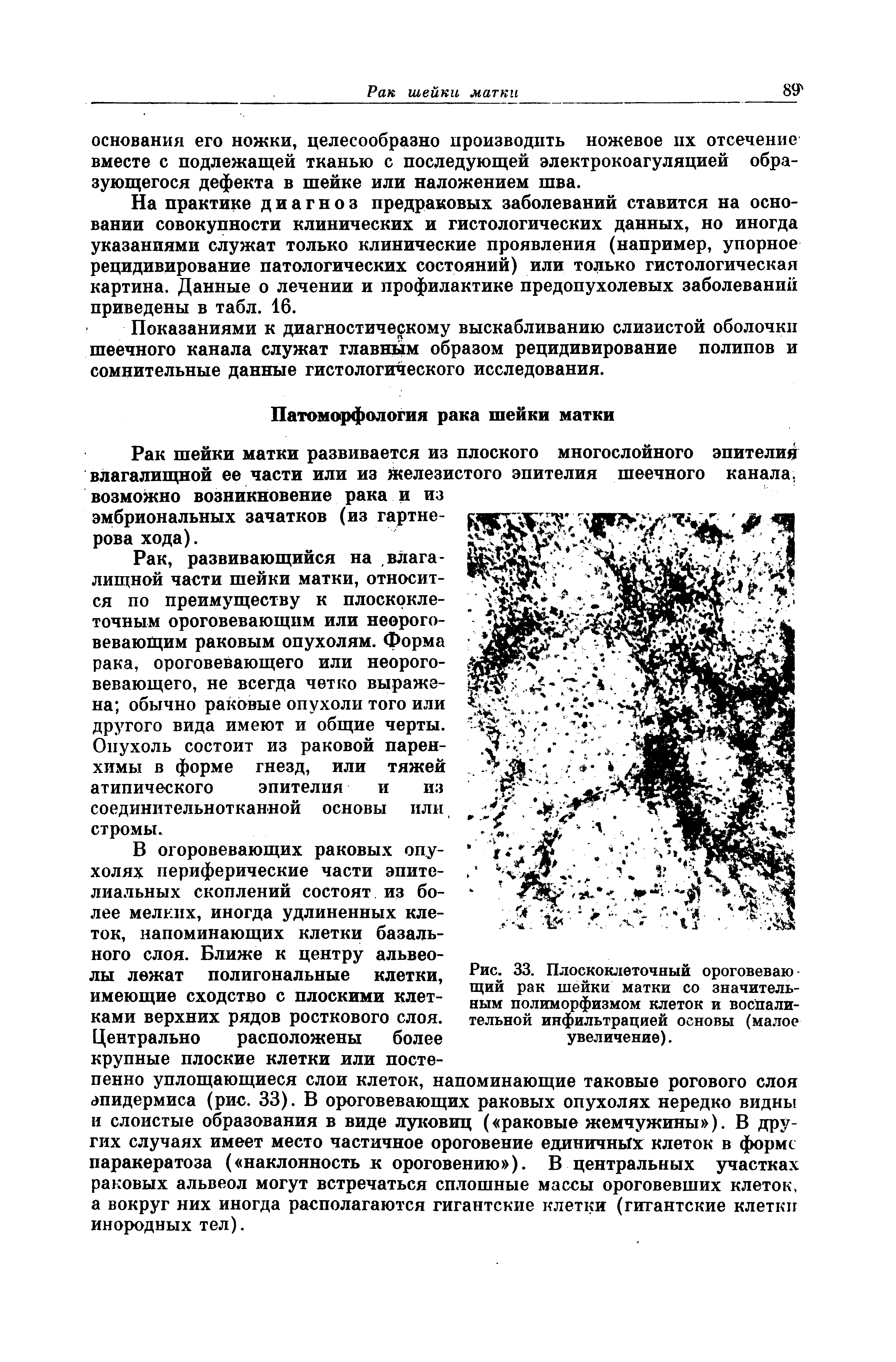 Рис. 33. Плоскоклеточный ороговеваю щий рак шейки матки со значительным полиморфизмом клеток и воспалительной инфильтрацией основы (малое увеличение).