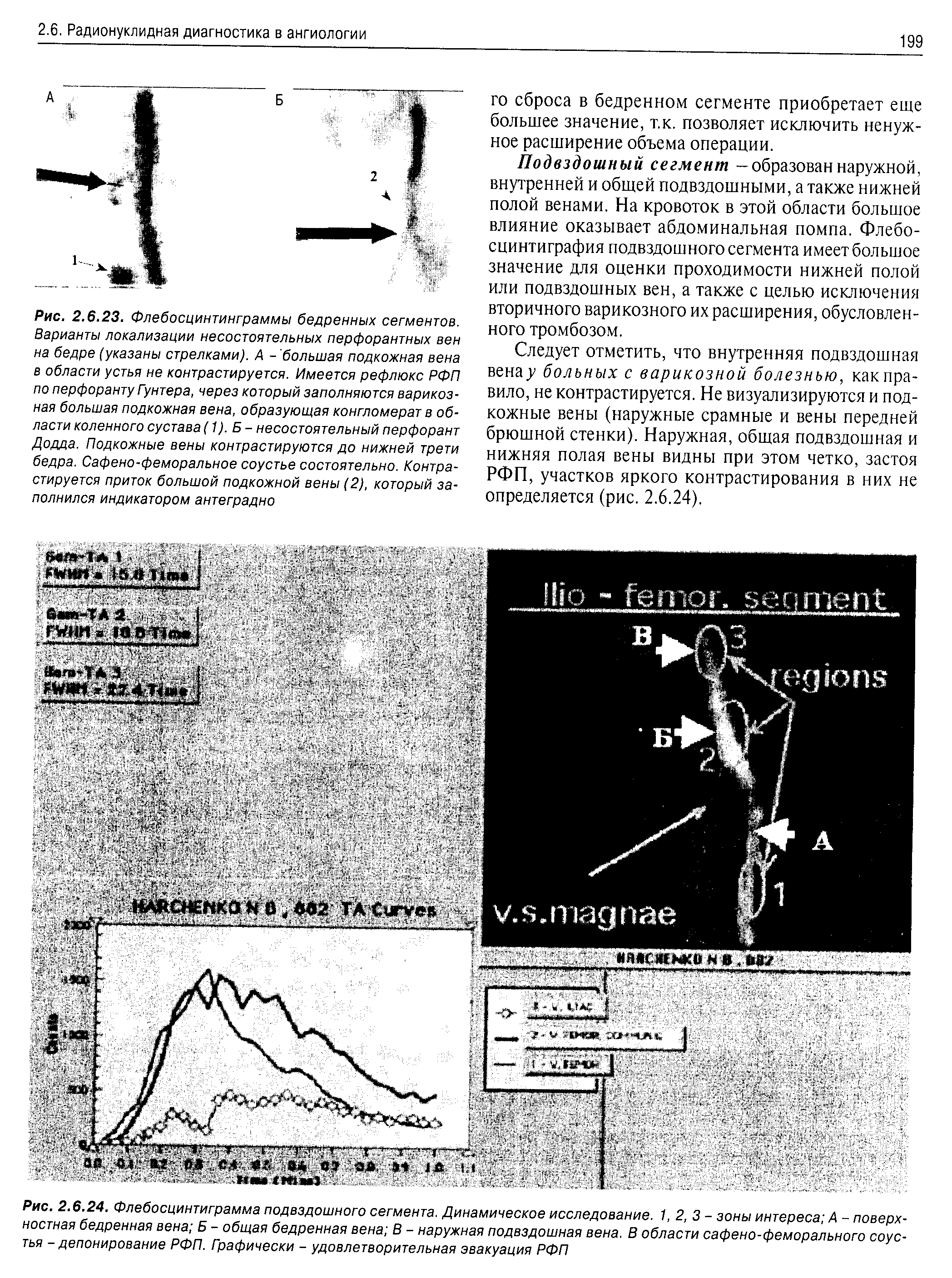 Рис. 2.6.24. Флебосцинтиграмма подвздошного сегмента. Динамическое исследование. 1, 2, 3 - зоны интереса А - поверхностная бедренная вена Б - общая бедренная вена В - наружная подвздошная вена. В области сафено-феморального соустья -депонирование РФП. Графически - удовлетворительная эвакуация РФП...