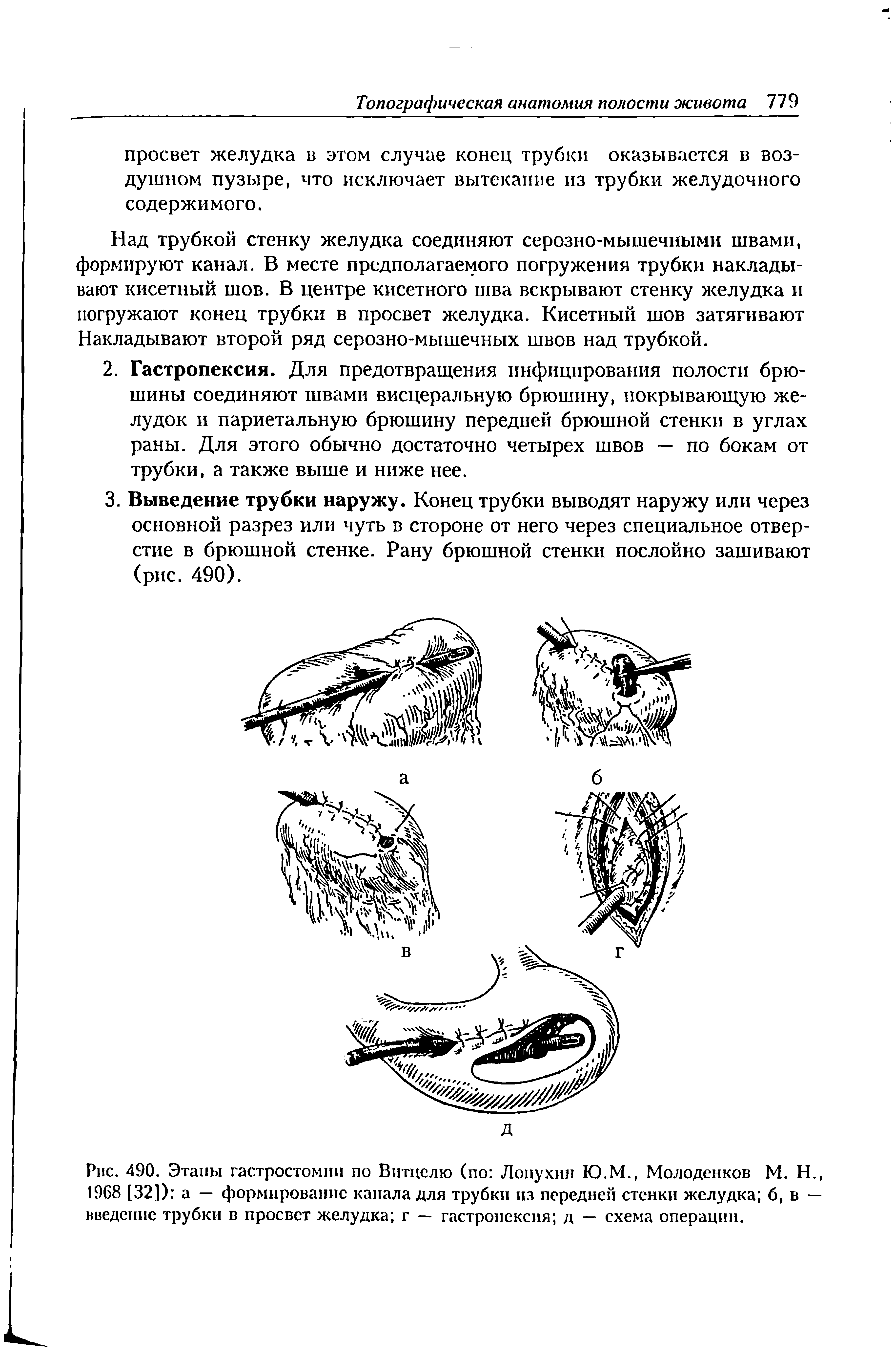 Рис. 490. Этапы гастростомии по Витцелю (по Лопухин Ю.М., Молоденков М. Н., 1968 [32]) а — формирование капала для трубки из передней стенки желудка б, в — введение трубки в просвет желудка г — гастропексия д — схема операции.