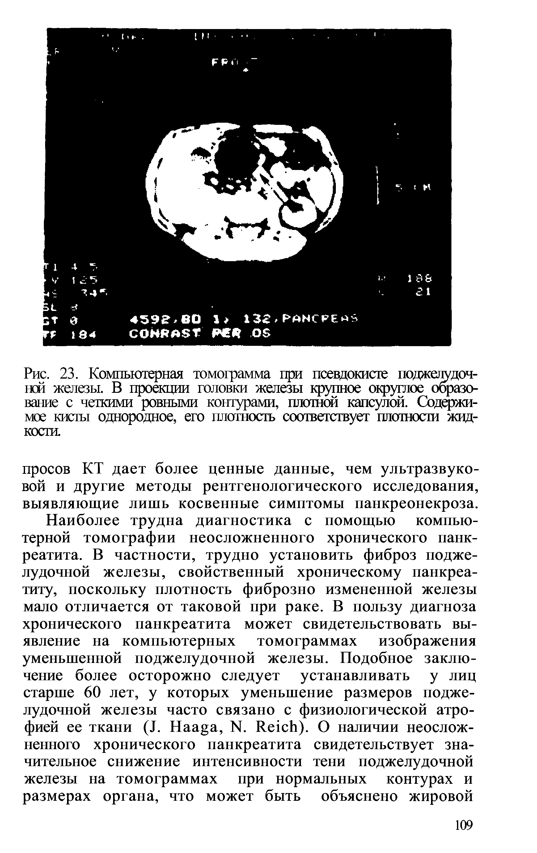 Рис. 23. Компьютерная томограмма при псевдокисте поджелудочной железы. В проекции головки железы крупное округлое образование с четкими ровными контурами, плотной капсулой. Содержимое кисты однородное, его плотность соответствует плотности жидкости.