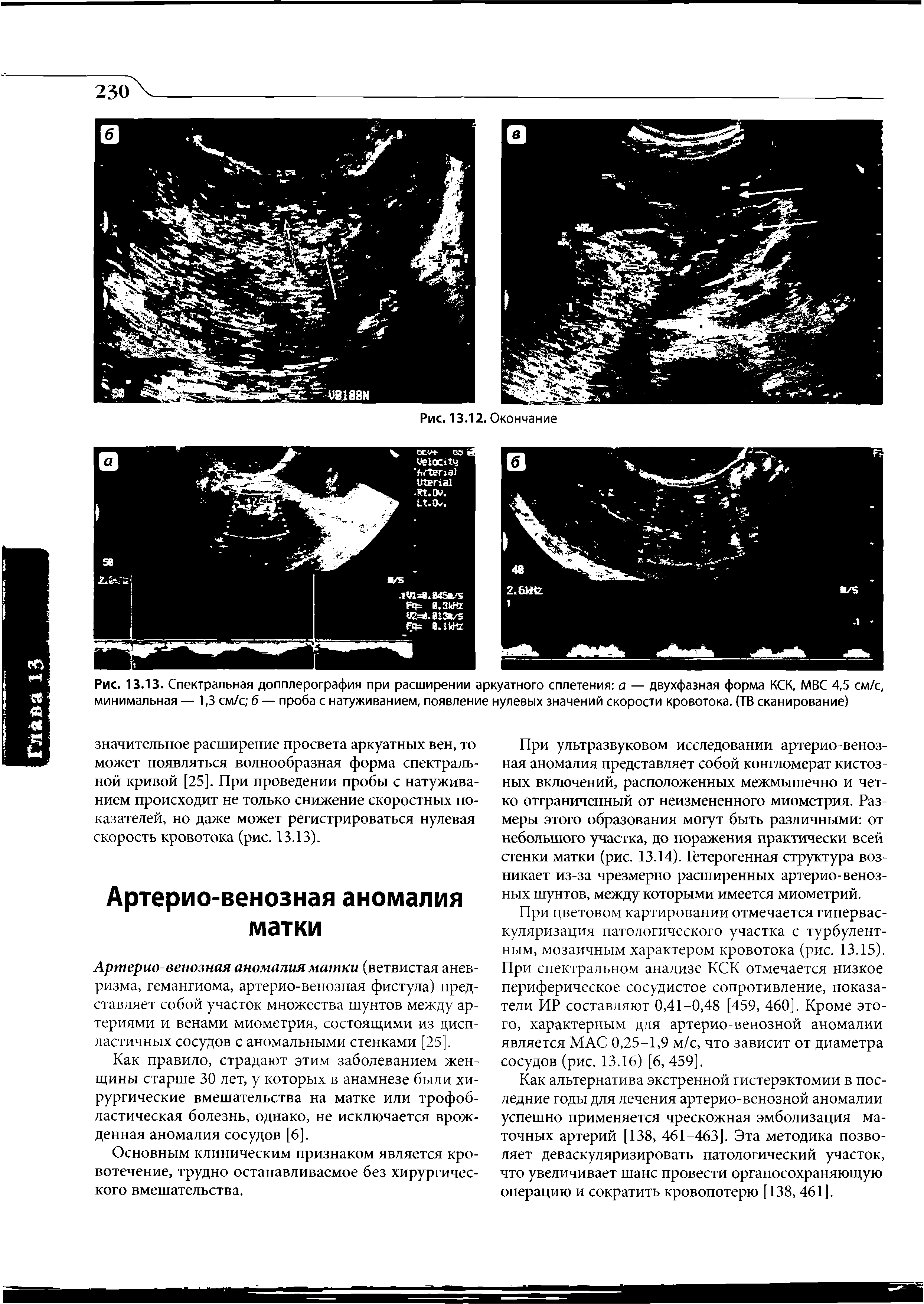 Рис. 13.13. Спектральная допплерография при расширении аркуатного сплетения а — двухфазная форма КСК, МВС 4,5 см/с, минимальная — 1,3 см/с б— проба с натуживанием, появление нулевых значений скорости кровотока. (ТВ сканирование)...