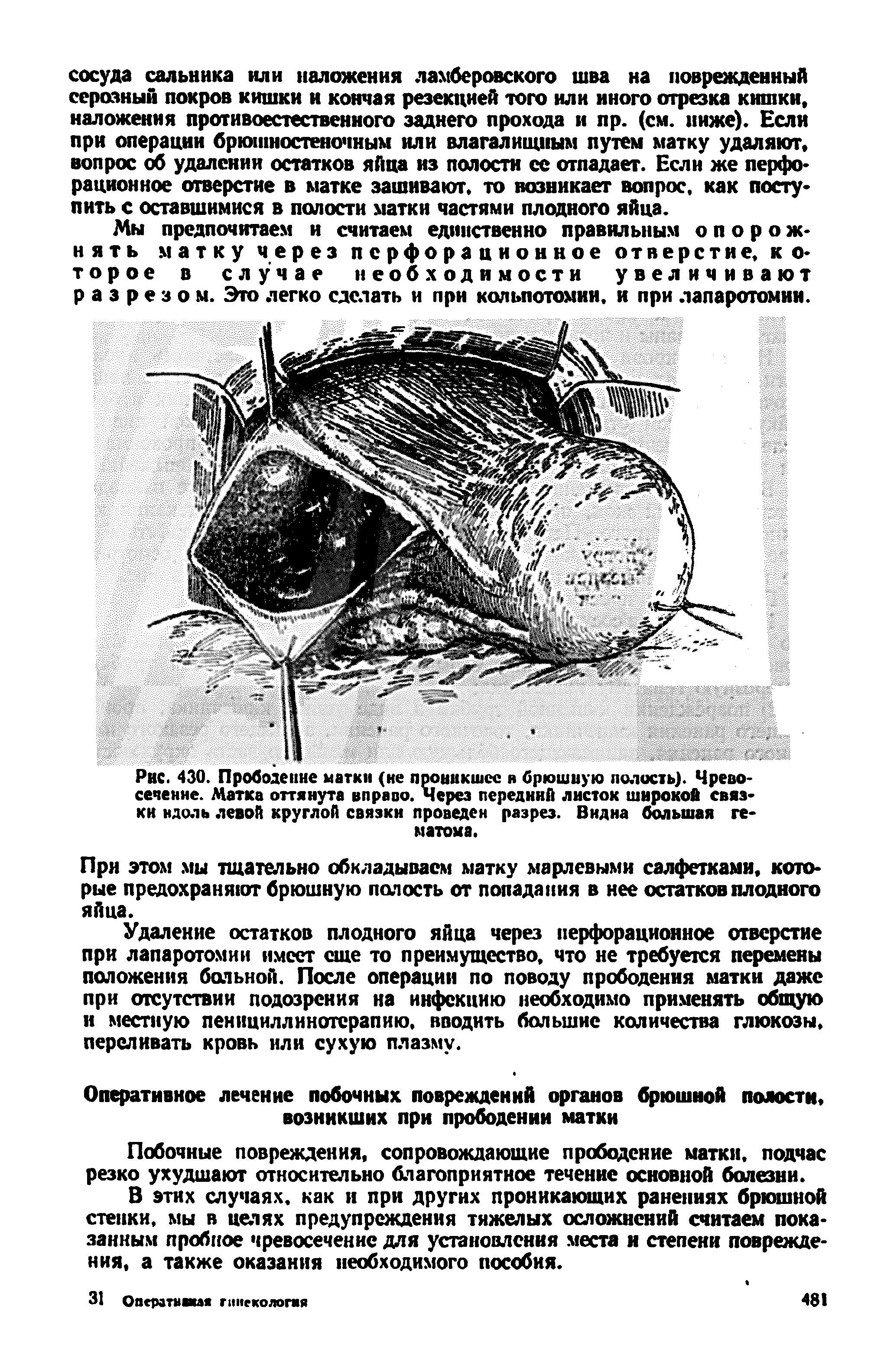 Рис. 430. Прободение матки (не проникшее н брюшную полость). Чревосечение. Матка оттянута вправо. Через передний листок широкой связки ндоль левой круглой связки проведен разрез. Видна большая гематома.