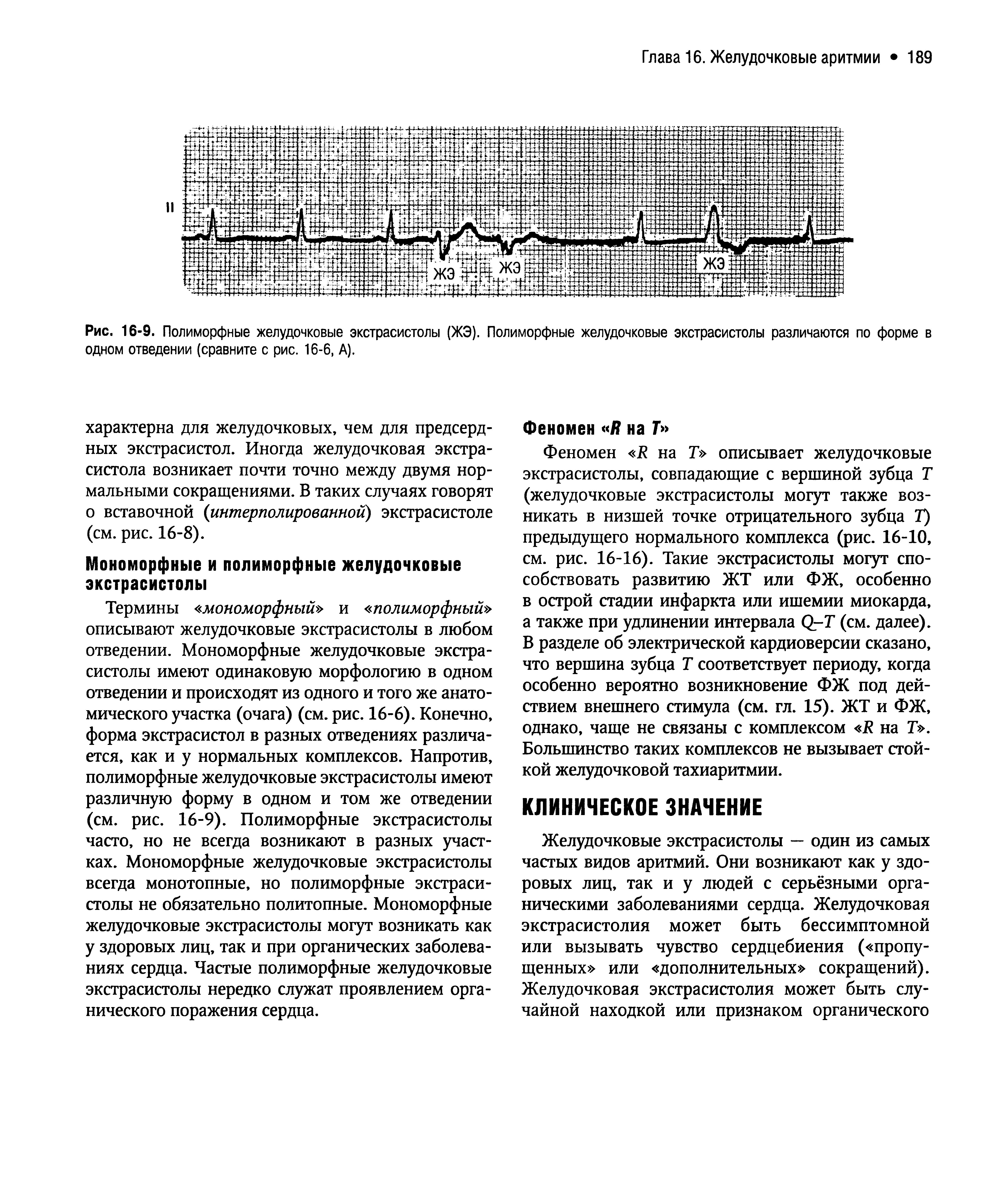 Рис. 16-9. Полиморфные желудочковые экстрасистолы (ЖЭ). Полиморфные желудочковые экстрасистолы различаются по форме в одном отведении (сравните с рис. 16-6, А).