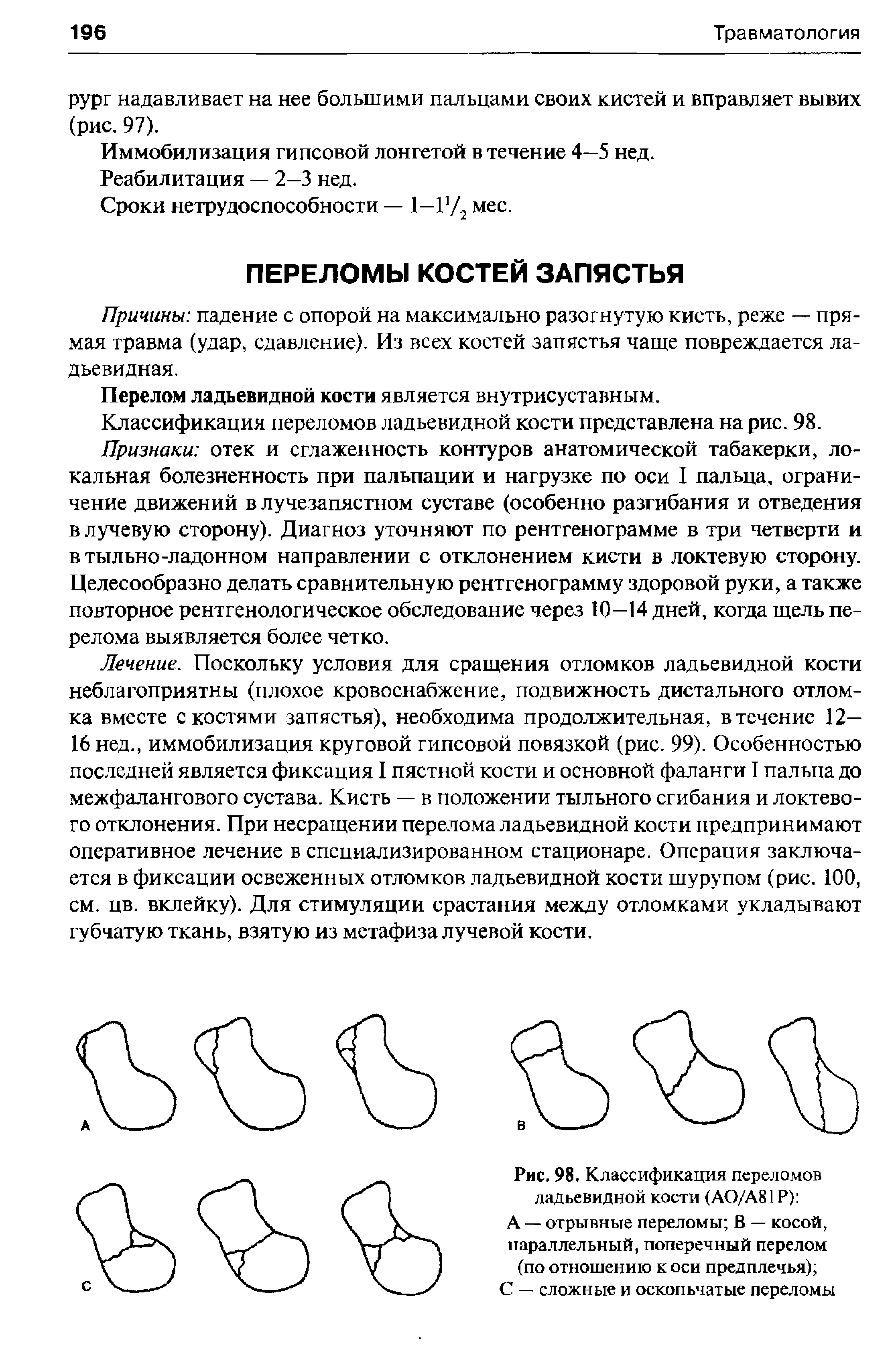 Рис. 98. Классификация переломов ладьевидной кости (АО/А81Р) А — отрывные переломы В — косой, параллельный, поперечный перелом (по отношению к оси предплечья), С — сложные и оскопьчатые переломы...