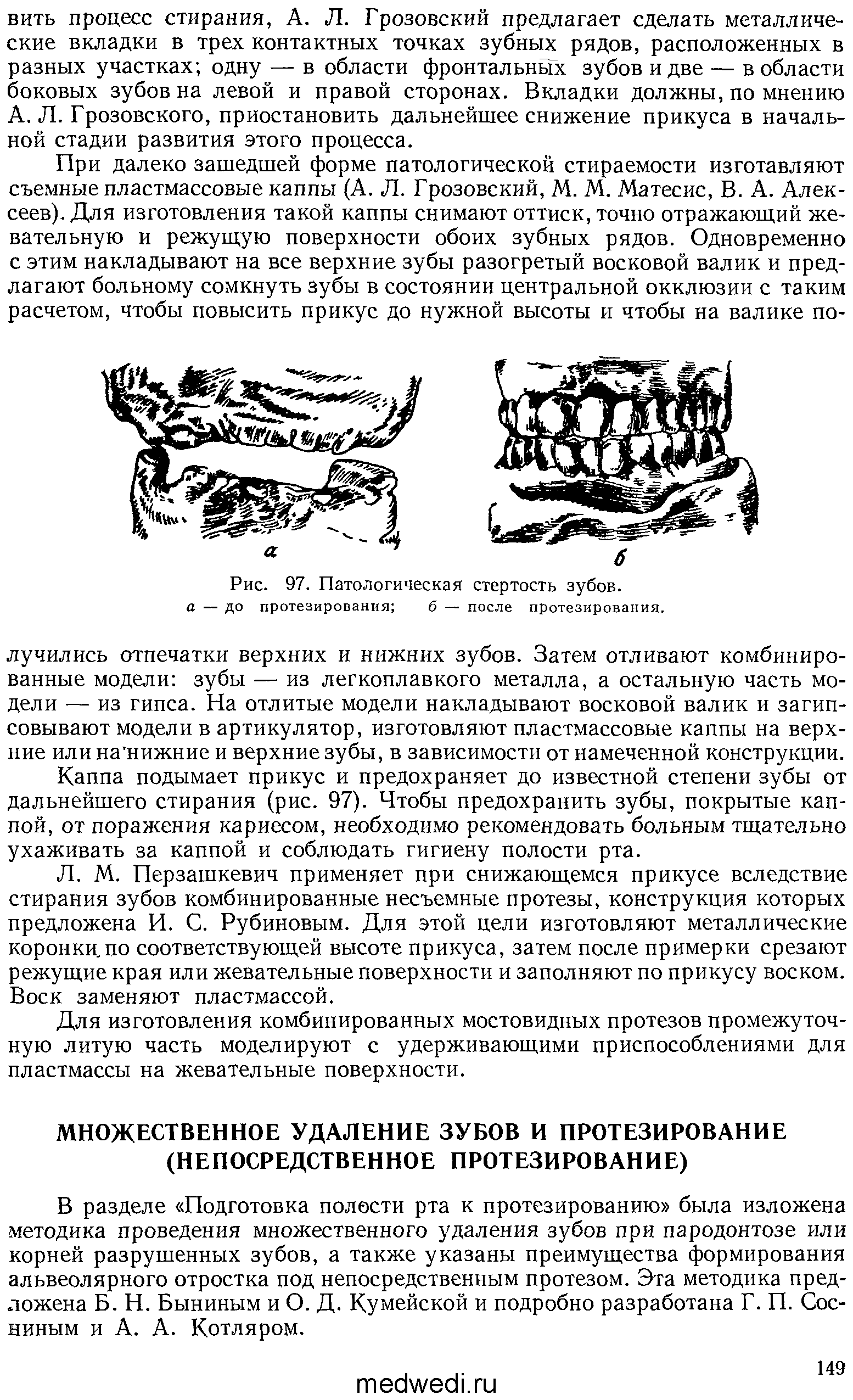 Рис. 97. Патологическая стертость зубов. а — до протезирования б — после протезирования.