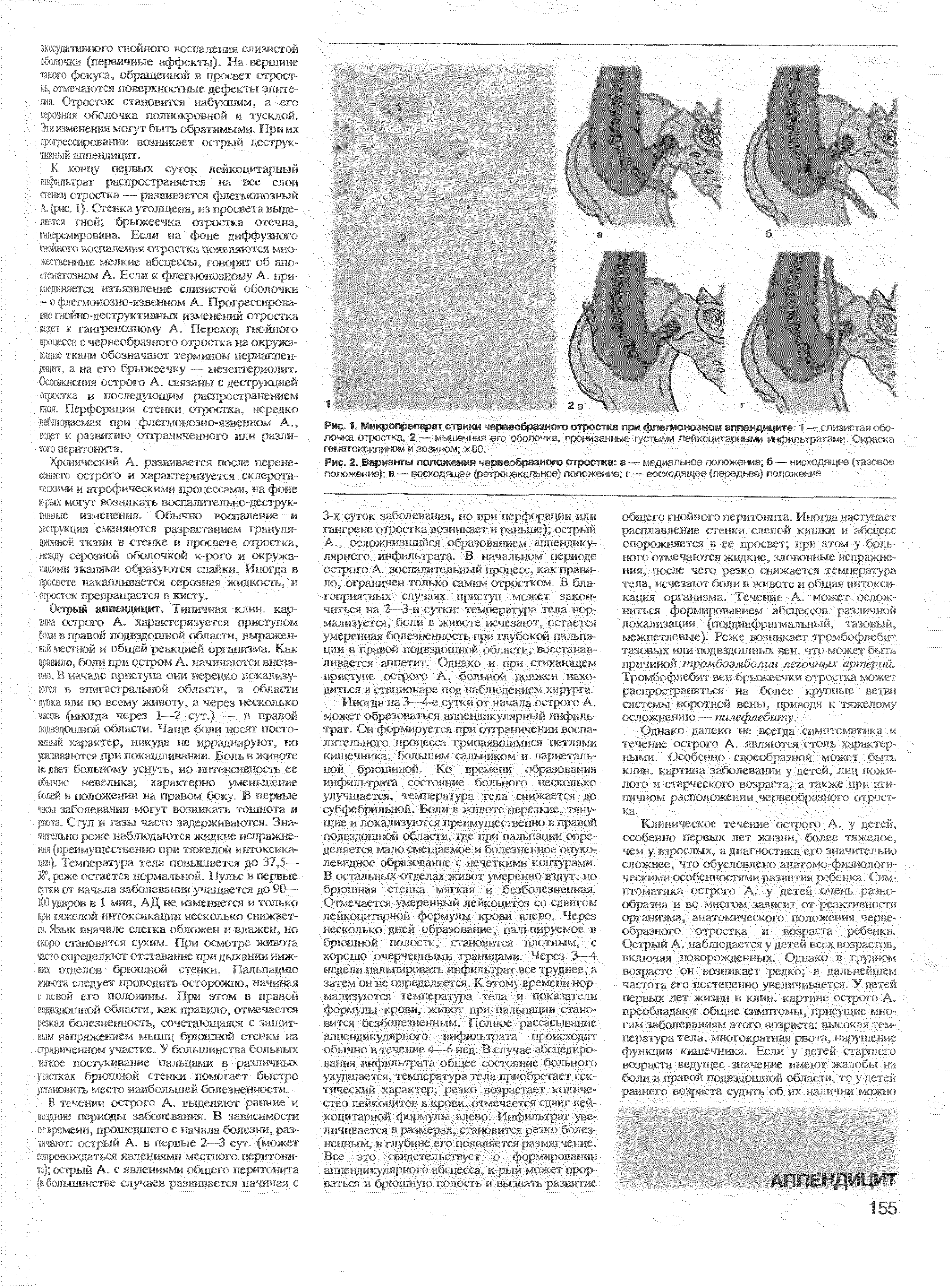 Рис. 1. Микропрепарат стенки червеобразного отростка при флегмонозном аппендиците 1 -г слизистая оболочка >< ( . 2 — I кг- к, I <( г п(, 1 ., ные густыми лейкоцитарными инфильтратами.Окраска гематлигмлииом и эозинам- кчо у < (те...