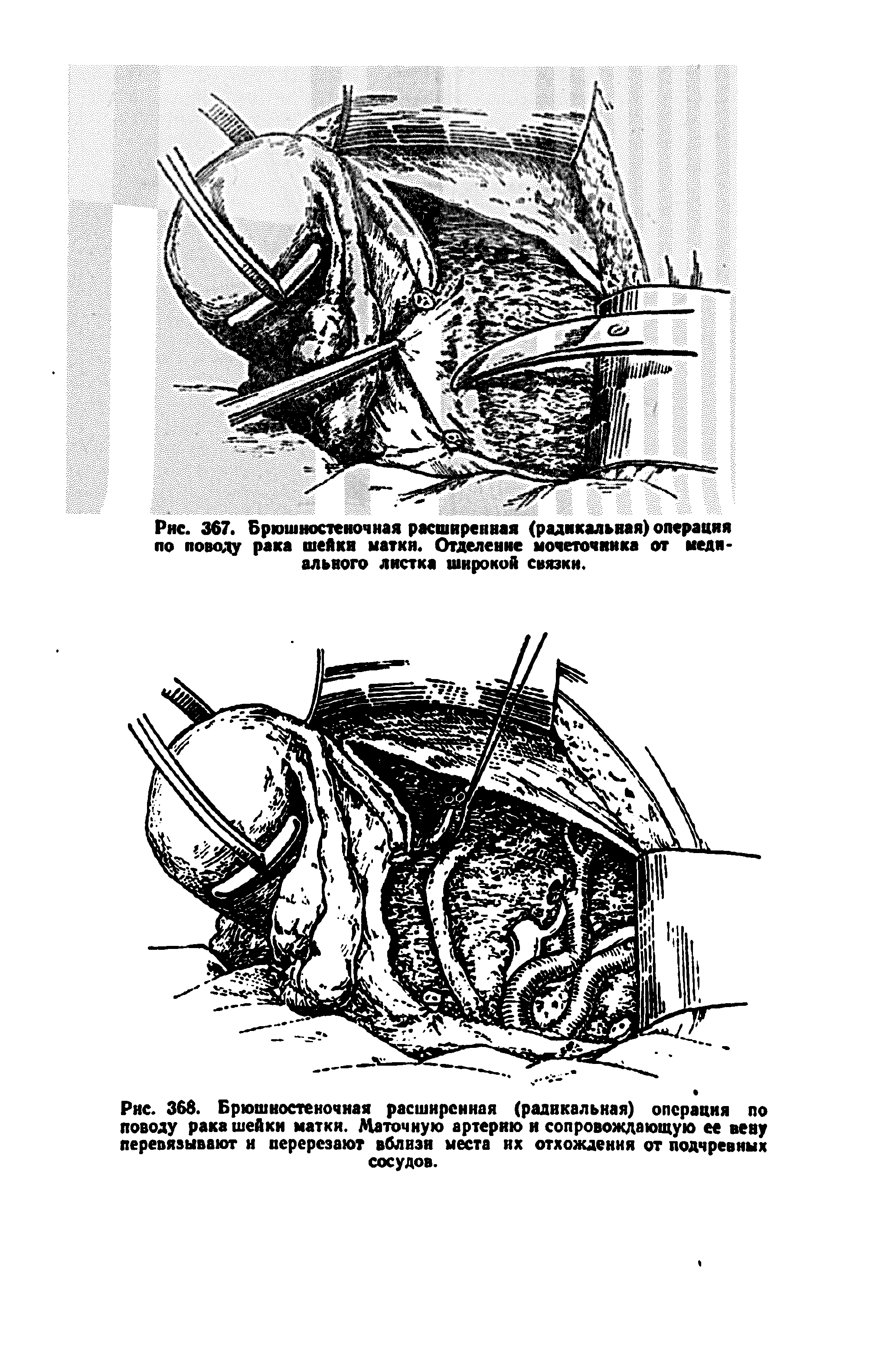 Рис. 368. Брюшностеночная расширенная (радикальная) операция по поводу рака шейки маткя. Маточную артерию я сопровождающую ее вену перевязывают и перерезают вблизи места их отхождения от подчревных сосудов.