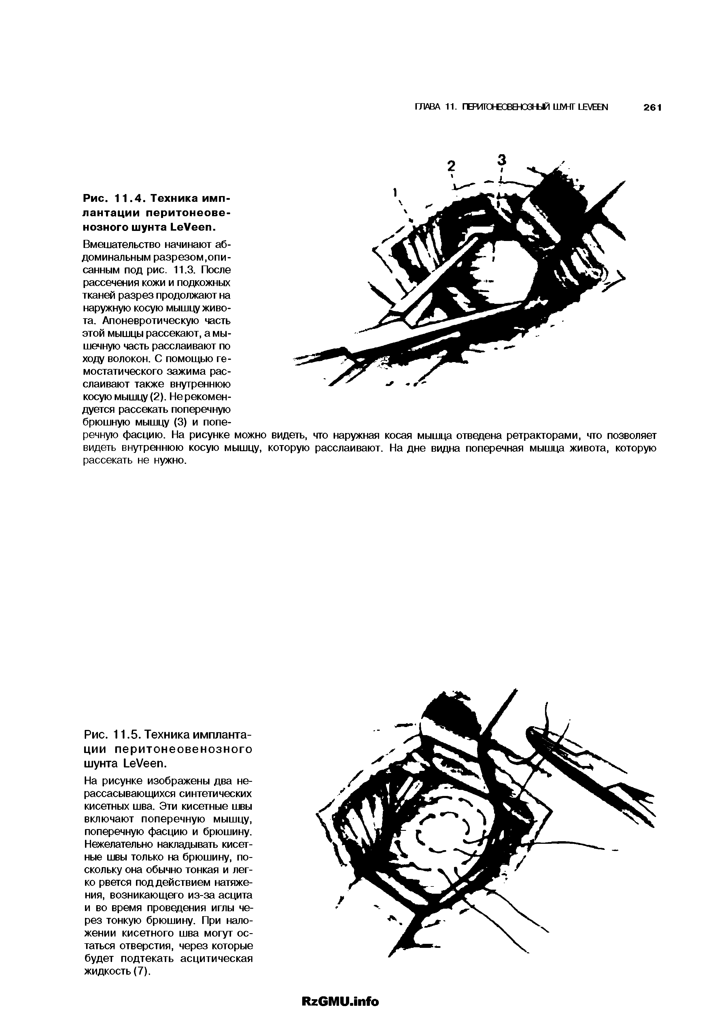 Рис. 11.4. Техника имплантации перитонеове-нозного шунта L V .