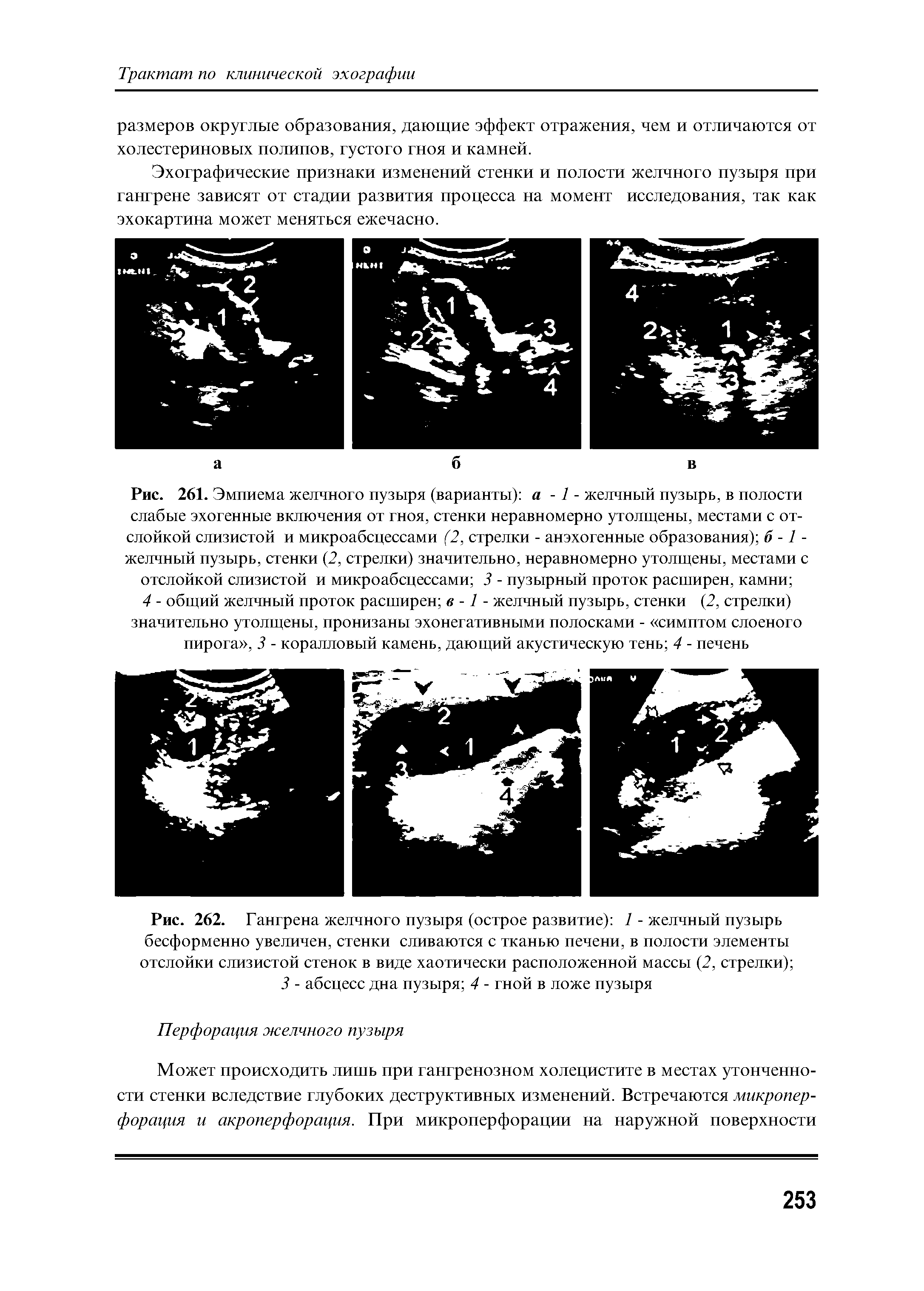 Рис. 262. Гангрена желчного пузыря (острое развитие) 1 - желчный пузырь бесформенно увеличен, стенки сливаются с тканью печени, в полости элементы отслойки слизистой стенок в виде хаотически расположенной массы (2, стрелки) ...