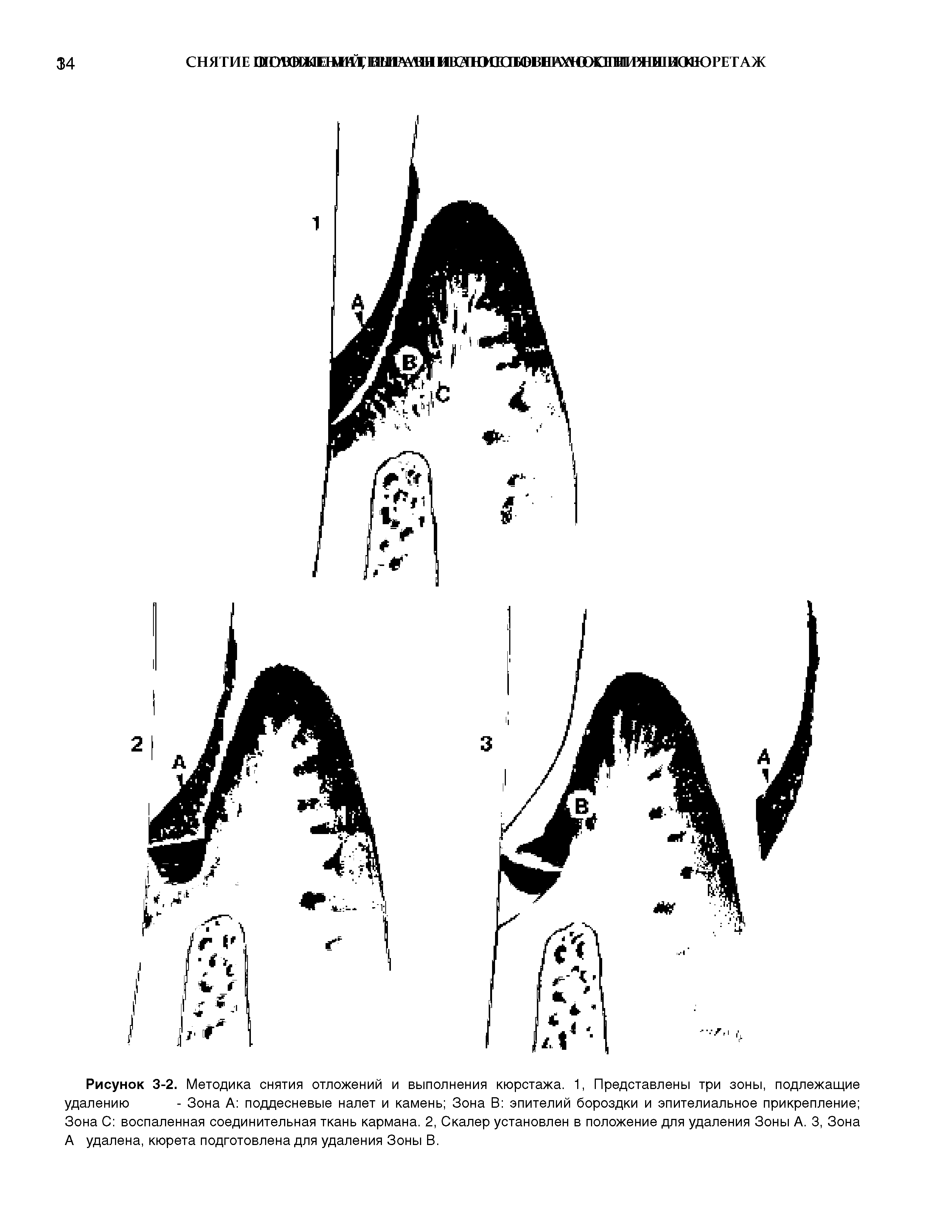 Рисунок 3-2. Методика снятия отложений и выполнения кюретажа. 1, Представлены три зоны, подлежащие удалению - Зона А поддесневые налет и камень Зона В эпителий бороздки и эпителиальное прикрепление ...