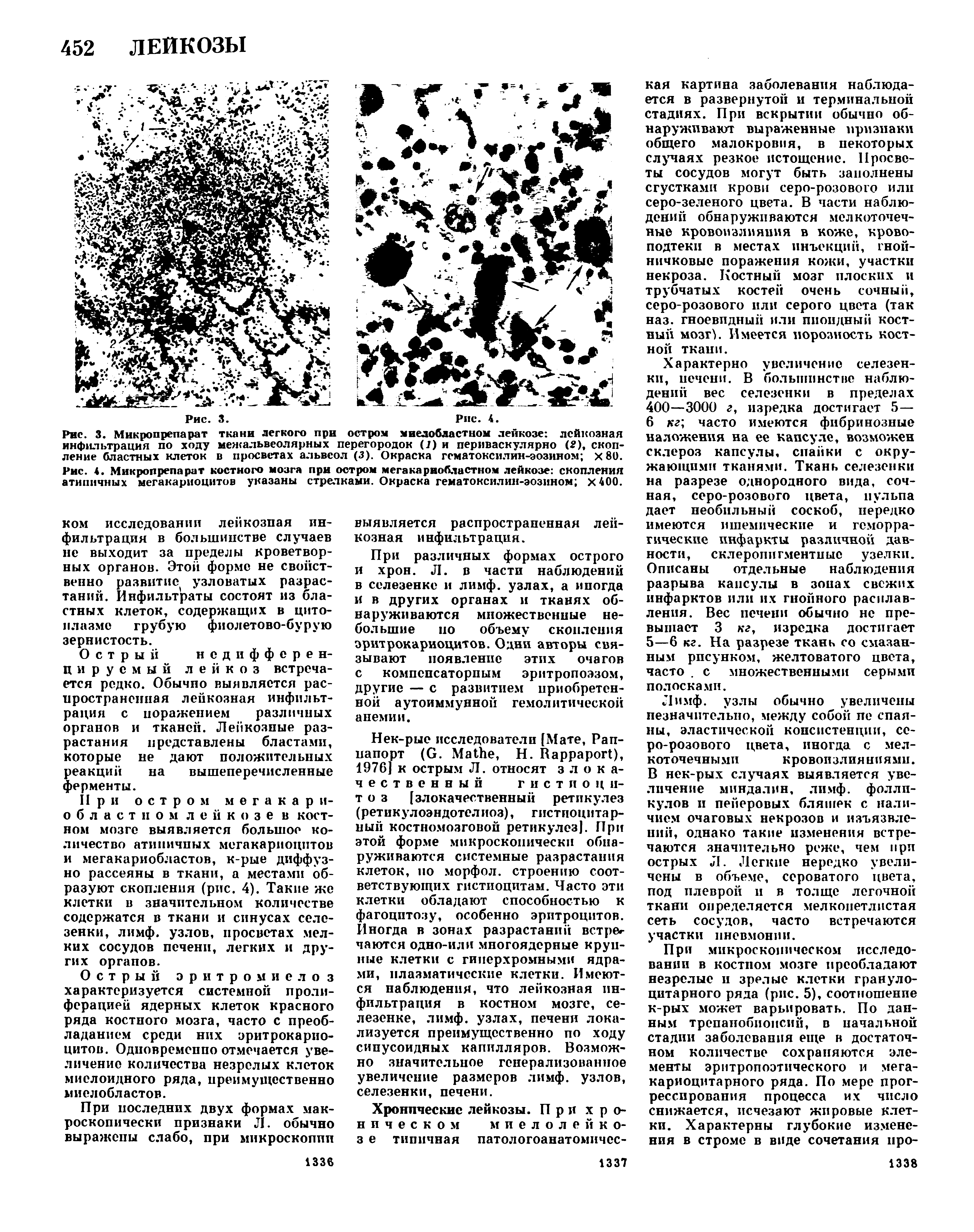 Рис. 4. Микропрепарат костного мозга при остром мегакариобластном лейкозе скопления атипичных мегакариоцитов указаны стрелками. Окраска гематоксилнн-эозином х400.