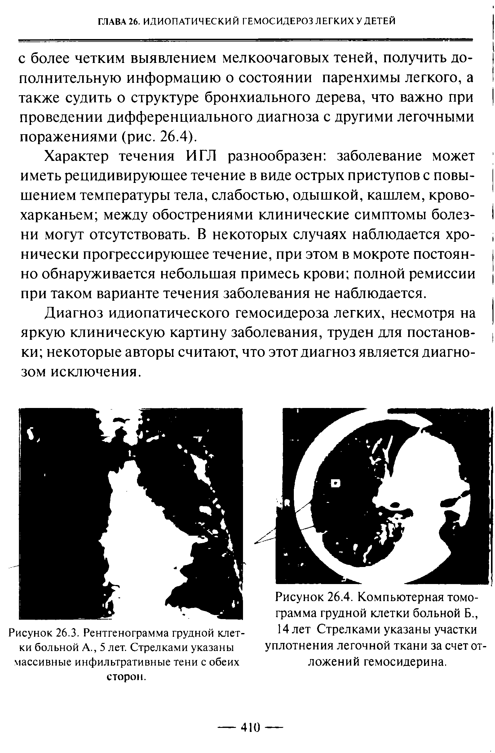 Рисунок 26.4. Компьютерная томограмма грудной клетки больной Б., 14 лет Стрелками указаны участки уплотнения легочной ткани за счет отложений гемосидерина.