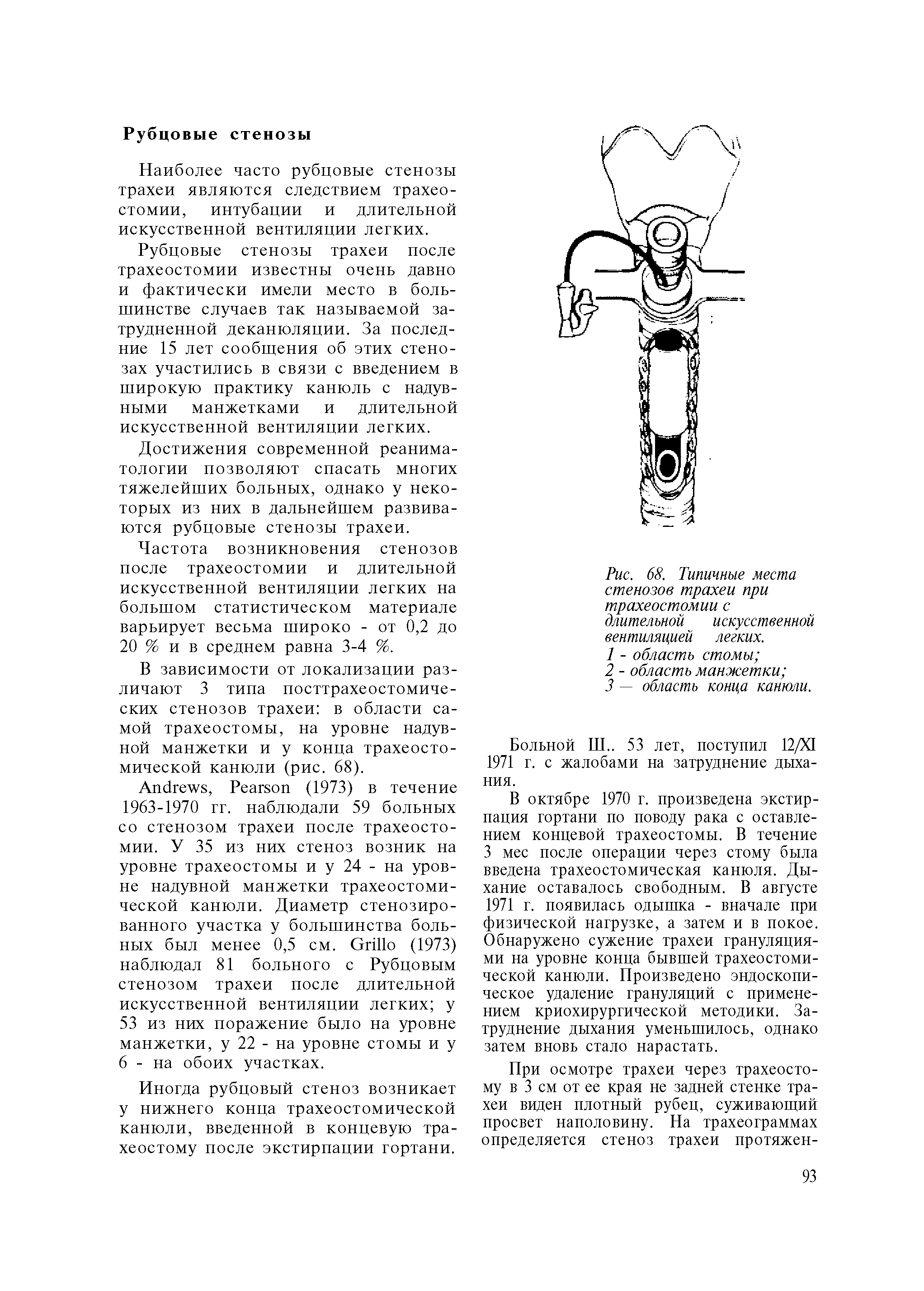 Рис. 68. Типичные места стенозов трахеи при трахеостомии с длительной искусственной вентиляцией легких.