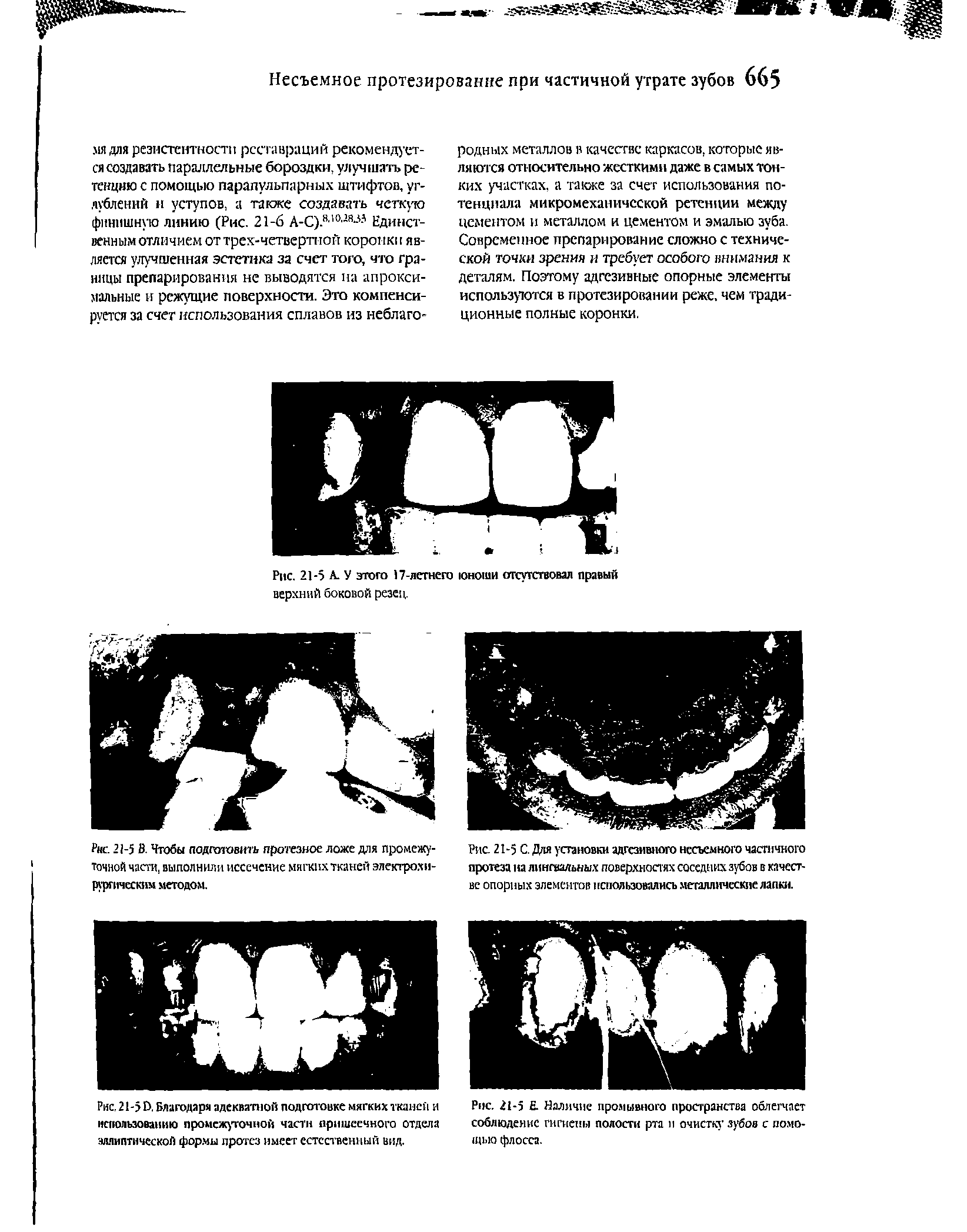 Рис. 21-5 С. Для установки адгезивного несъемного частичного протеза на лингвальных поверхностях соседних зубов в качестве опорных элементов использовались металлические лапки.