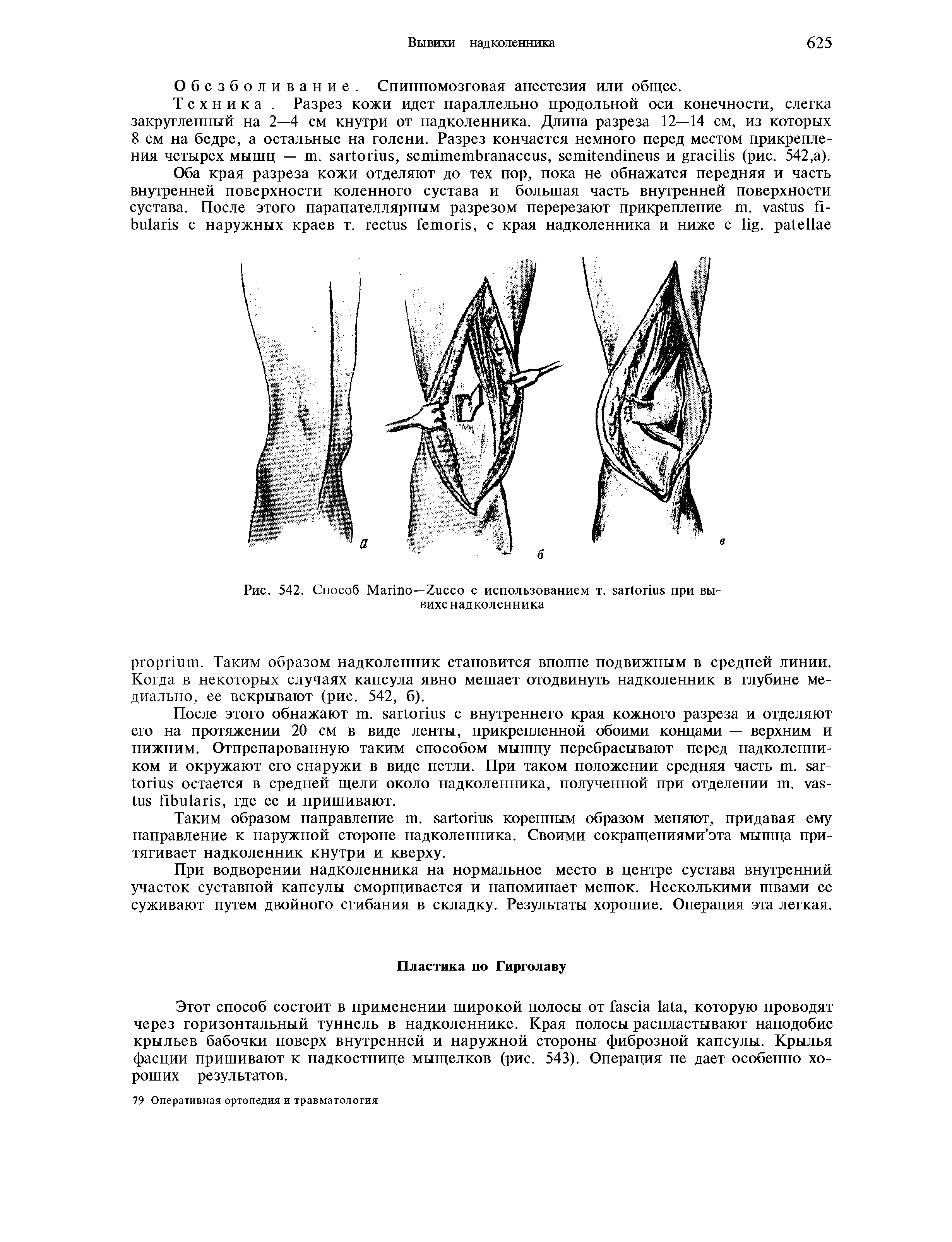 Рис. 542. Способ M —Z с использованием т. при вывихе надколенника...