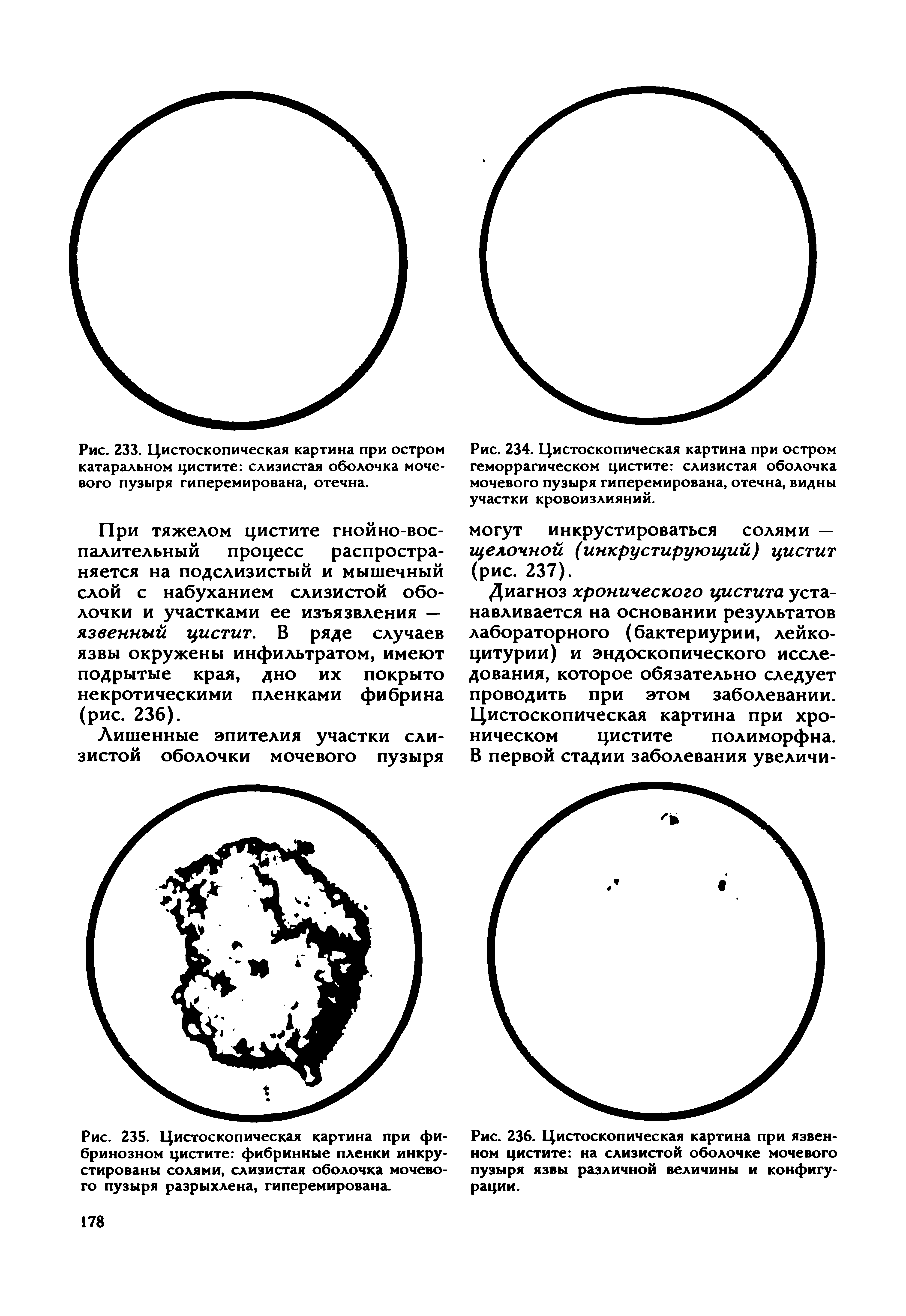 Рис. 235. Цистоскопическая картина при фибринозном цистите фибринные пленки инкрустированы солями, слизистая оболочка мочевого пузыря разрыхлена, гиперемирована.