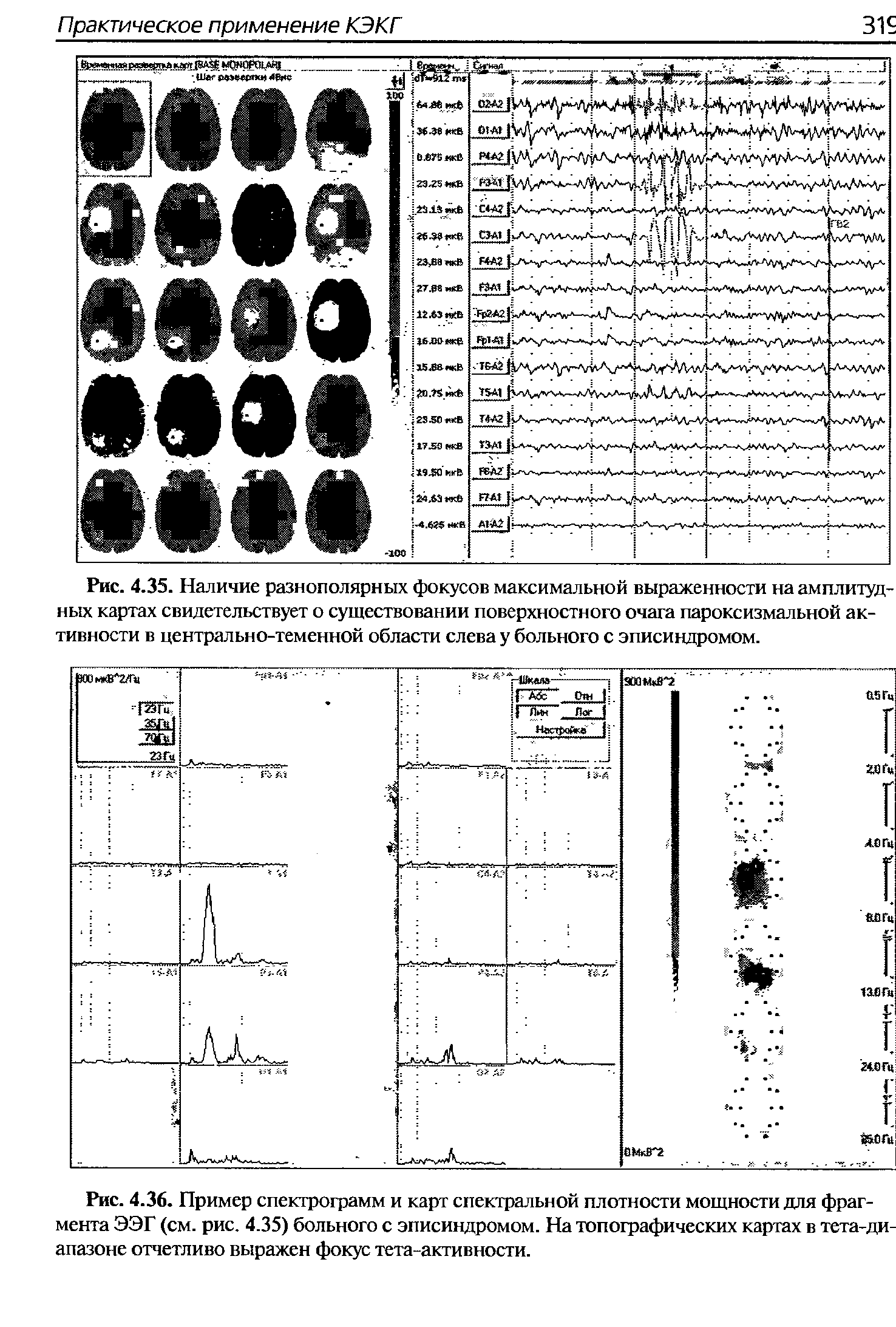 Рис. 4.35. Наличие разнополярных фокусов максимальной выраженности на амплитудных картах свидетельствует о существовании поверхностного очага пароксизмальной активности в центрально-теменной области слева у больного с эписиндромом.