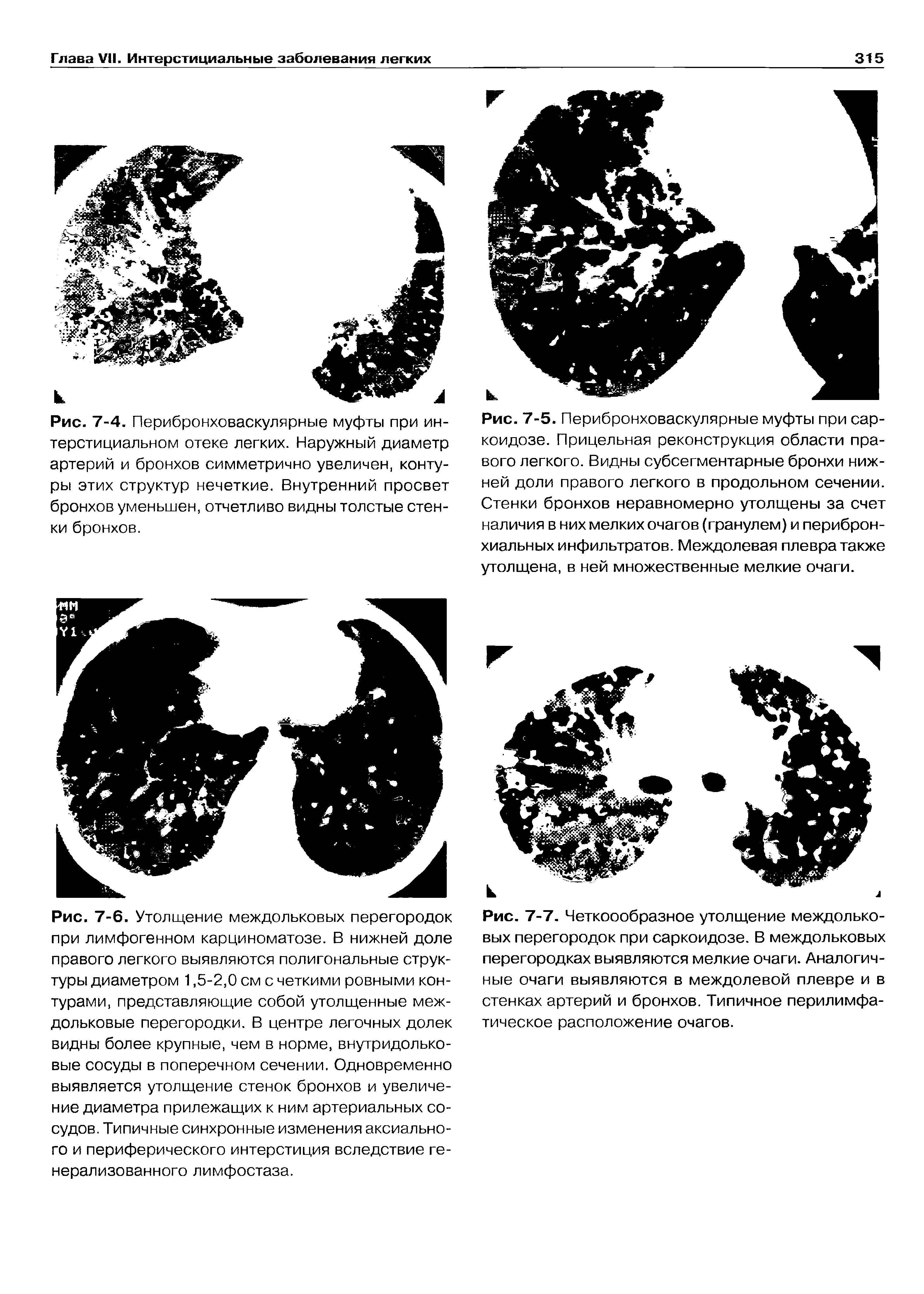 Рис. 7-7. Четкоообразное утолщение междольковых перегородок при саркоидозе. В междольковых перегородках выявляются мелкие очаги. Аналогичные очаги выявляются в междолевой плевре и в стенках артерий и бронхов. Типичное перилимфатическое расположение очагов.