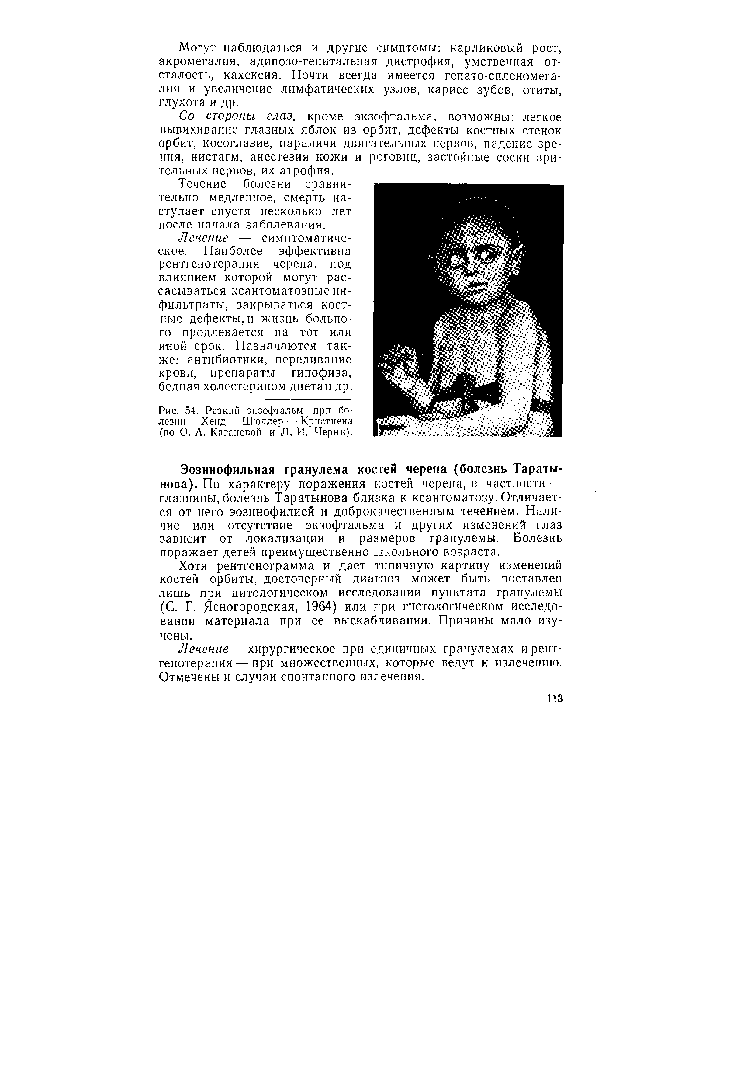 Рис. 54. Резкий экзофтальм при болезни Хенд — Шюллер — Кристиена (по О. А. Кагановой и Л. И. Черни).