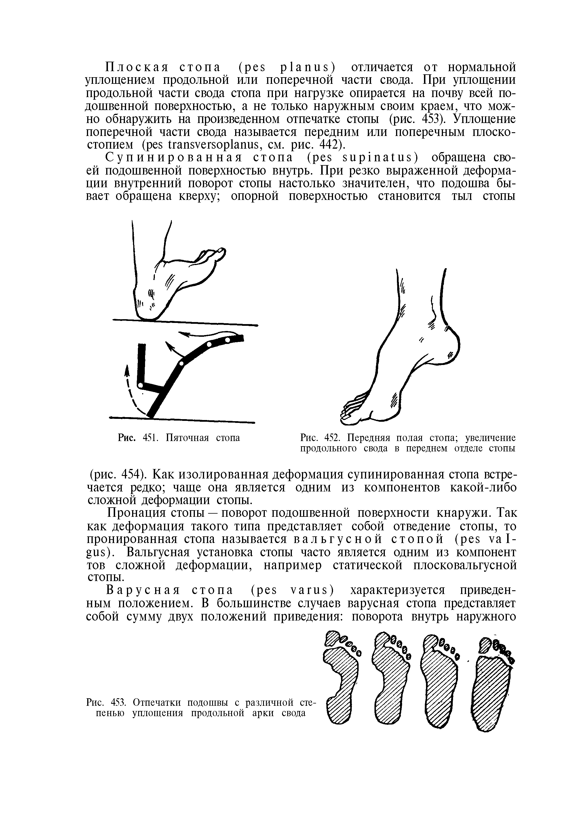Рис. 452. Передняя полая стопа увеличение продольного свода в переднем отделе стопы...