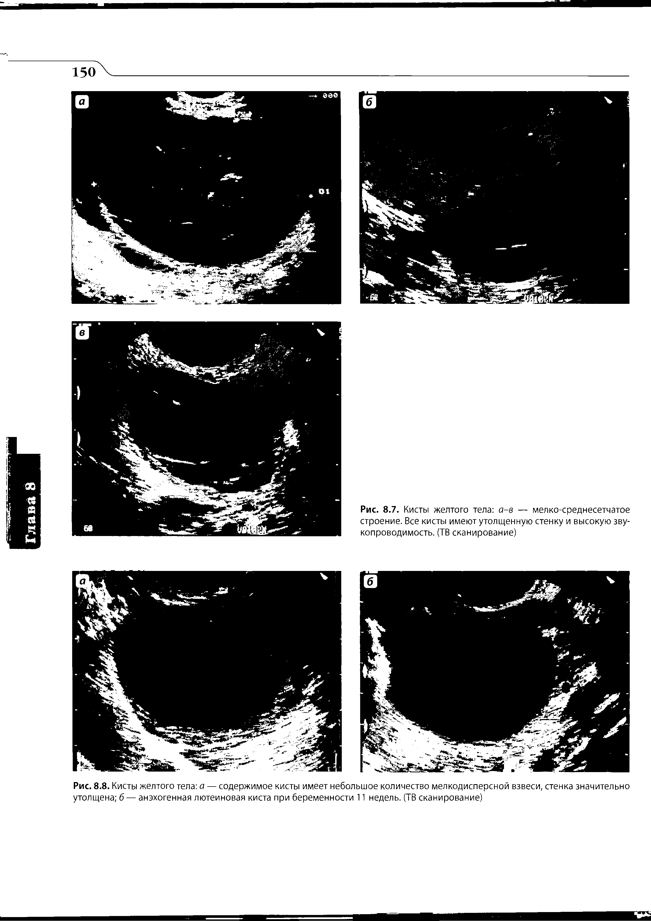 Рис. 8.8. Кисты желтого тела а — содержимое кисты имеет небольшое количество мелкодисперсной взвеси, стенка значительно утолщена б— анэхогенная лютеиновая киста при беременности 11 недель. (ТВ сканирование)...