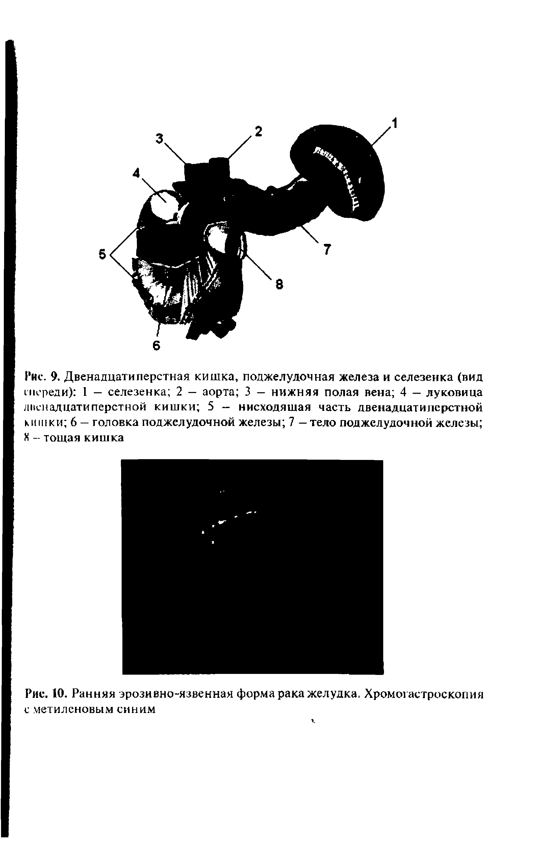 Рис. 10. Ранняя эрозивно-язвенная форма рака желудка, Хромогастроскопия с метиленовым синим...