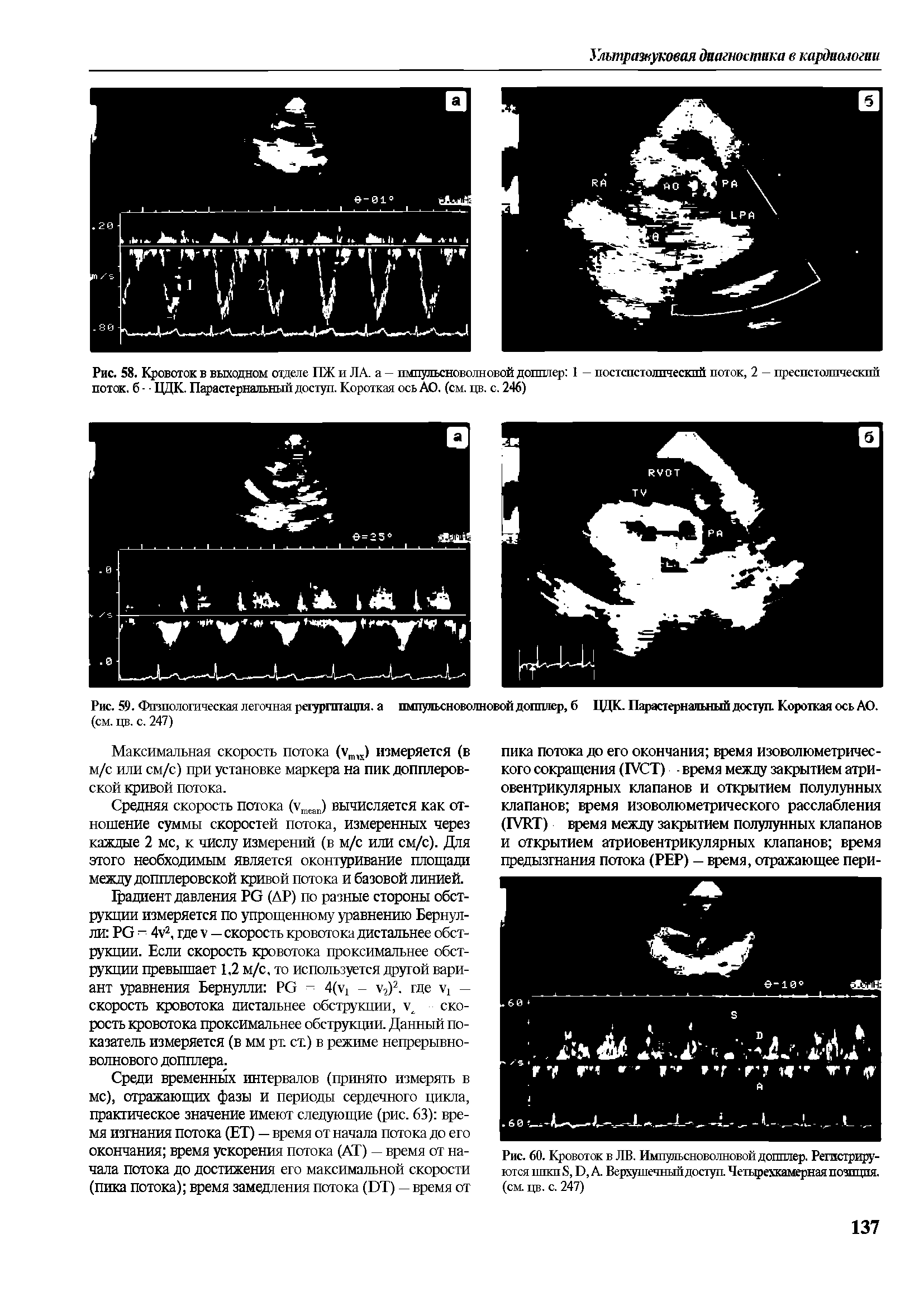 Рис. 60. Кровоток в ЛВ. Импульсноволновой допплер. Регистрируются ппкп 8, Б, А Верхушечный доступ. Четырехкамерная позиция, (см. цв. с. 247)...