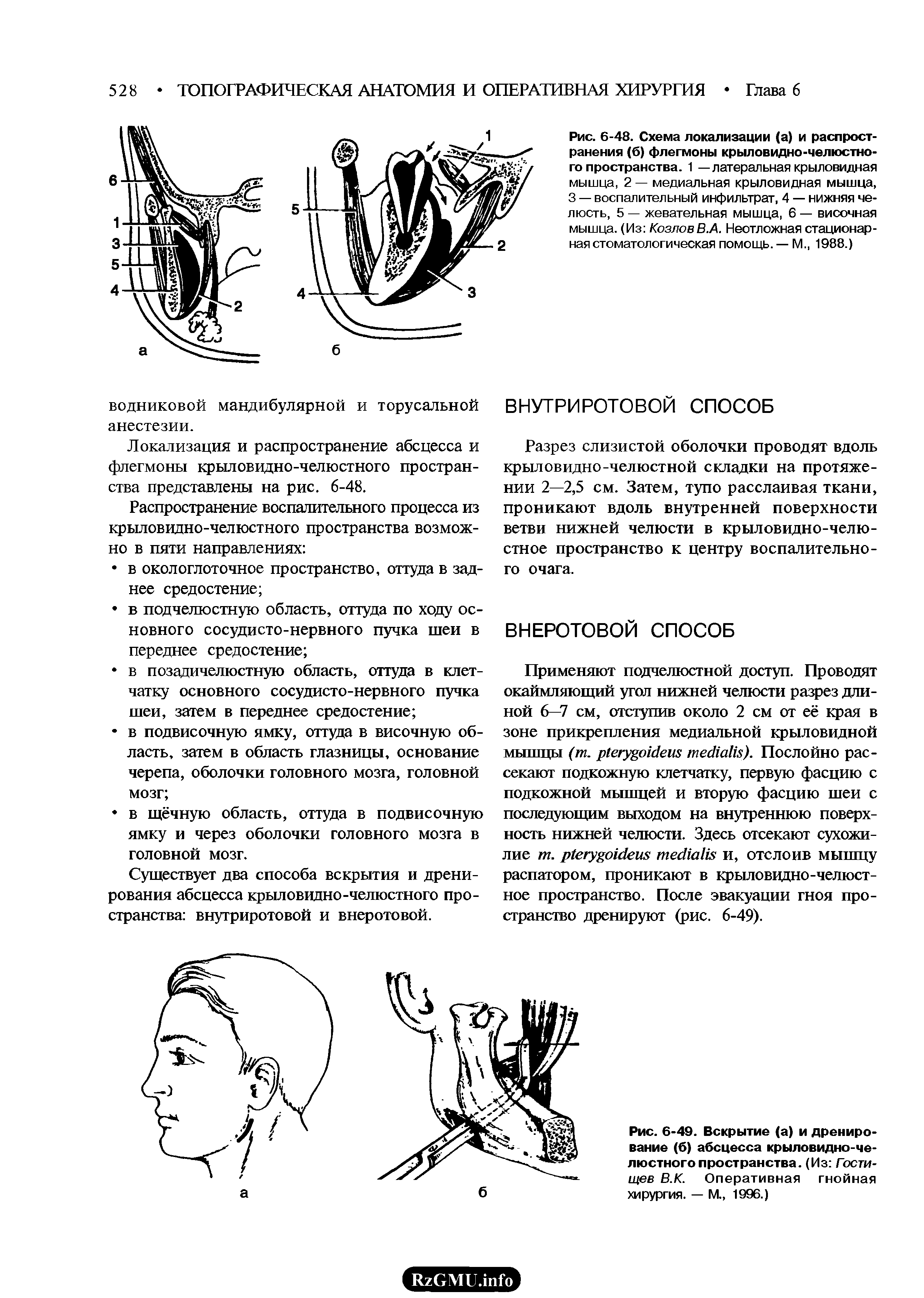 Рис. 6-48. Схема локализации (а) и распространения (б) флегмоны крыловидно-челюстного пространства. 1 — латеральная крыловидная мышца, 2 — медиальная крыловидная мышца, 3 — воспалительный инфильтрат, 4 — нижняя челюсть, 5 — жевательная мышца, 6 — височная мышца. (Из Козлов В.А. Неотложная стационарная стоматологическая помощь. — М., 1988.)...